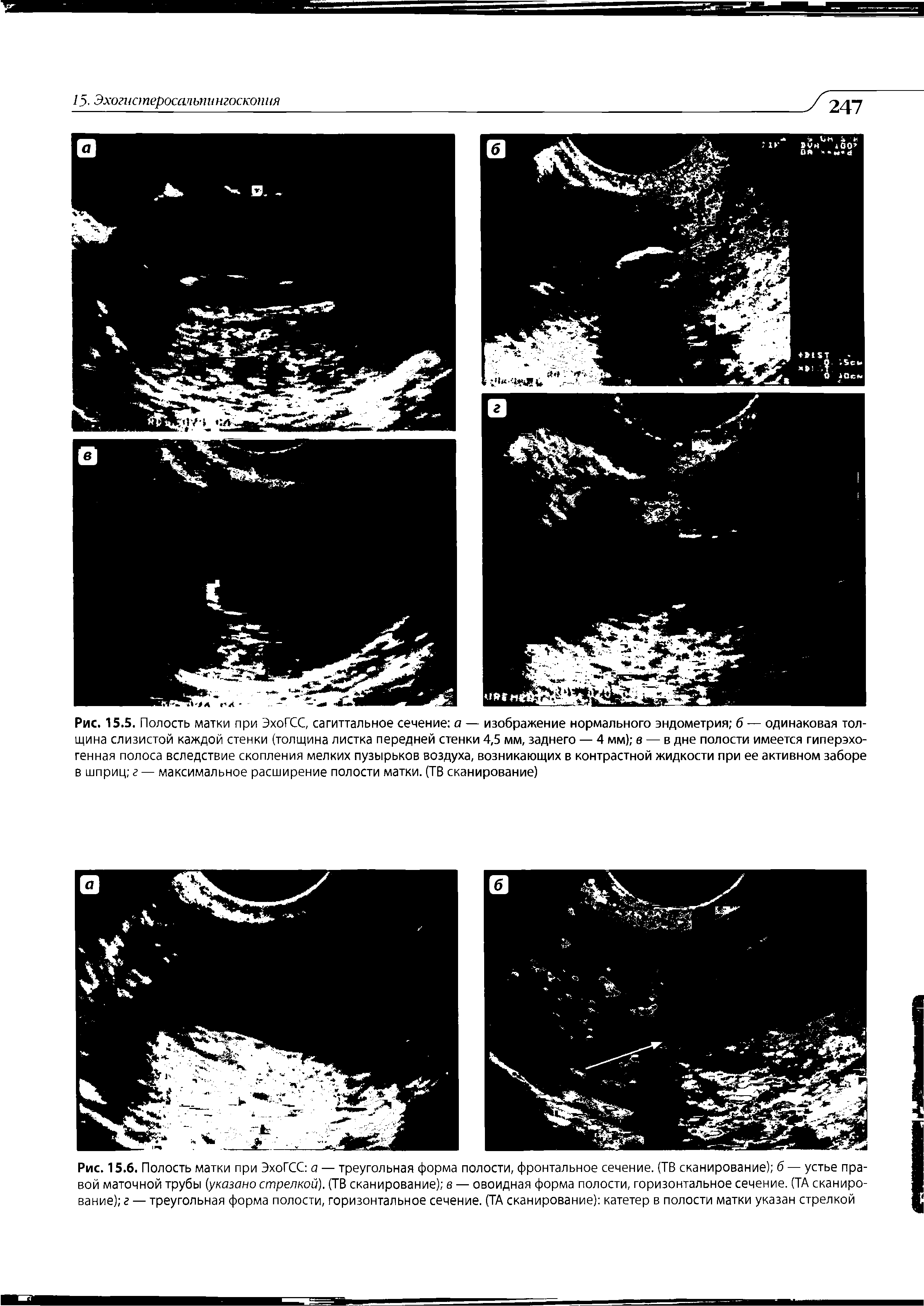 Рис. 15.6. Полость матки при ЭхоГСС а — треугольная форма полости, фронтальное сечение. (ТВ сканирование) б — устье правой маточной трубы (.указано стрелкой). (ТВ сканирование) в — овоидная форма полости, горизонтальное сечение. (ТА сканирование) г — треугольная форма полости, горизонтальное сечение. (ТА сканирование) катетер в полости матки указан стрелкой...