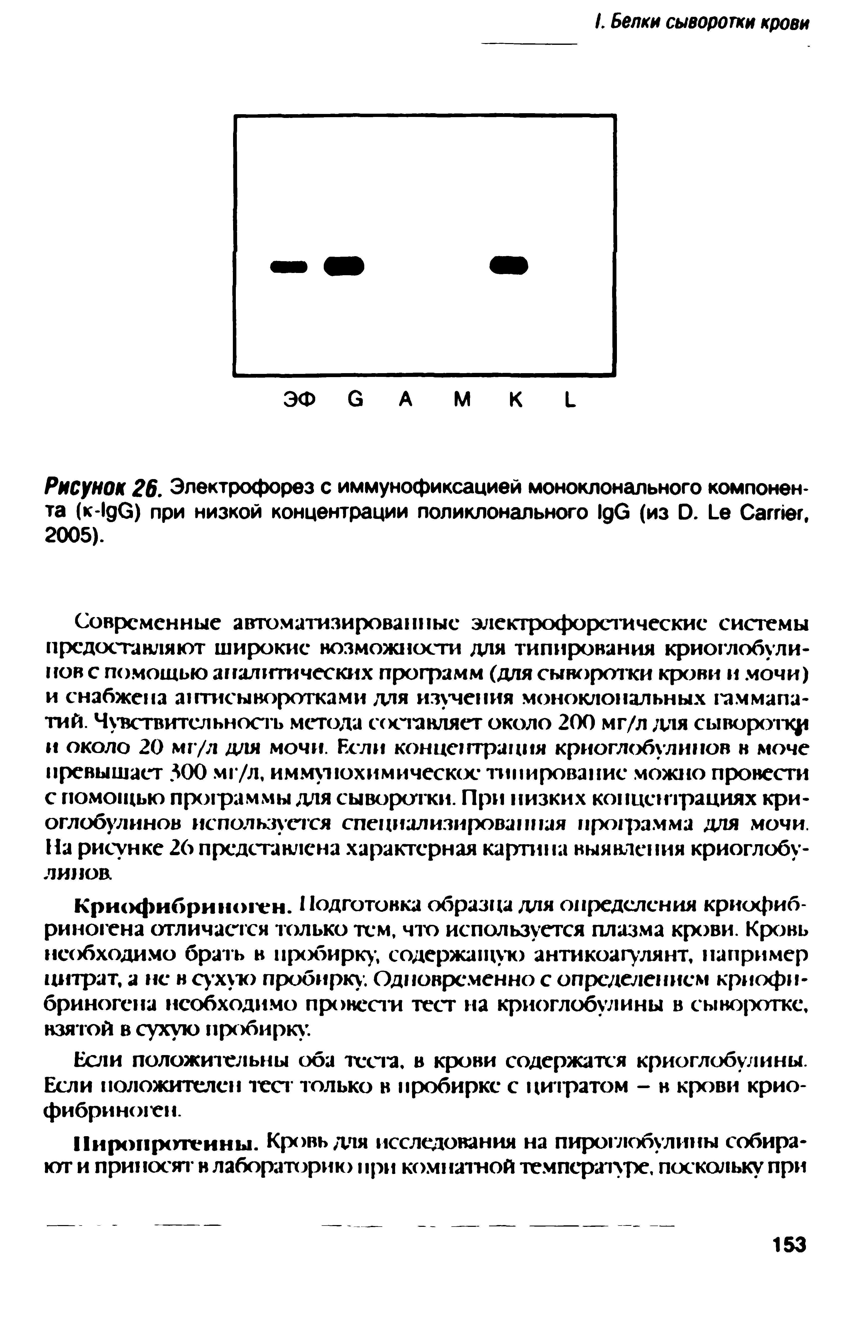 Рисунок 26. Электрофорез с иммунофиксацией моноклонального компонента (к-I G) при низкой концентрации поликлонального I G (из D. L C . 2005).