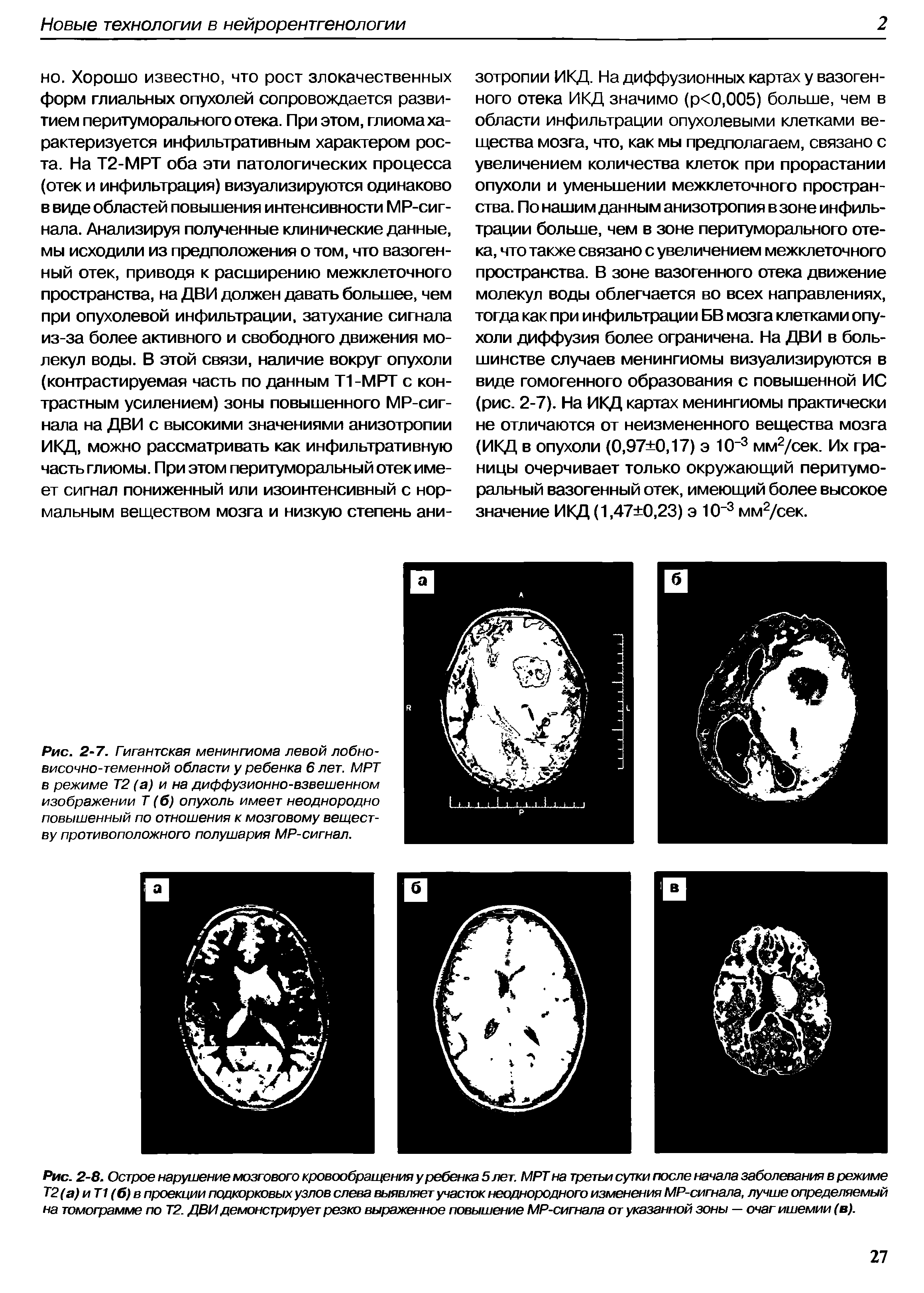 Рис. 2-7. Гигантская менингиома левой лобновисочно-теменной области у ребенка 6 лет. МРТ в режиме Т2 (а) и на диффузионно-взвешенном изображении Т (б) опухоль имеет неоднородно повышенный по отношения к мозговому веществу противоположного полушария МР-сигнал.
