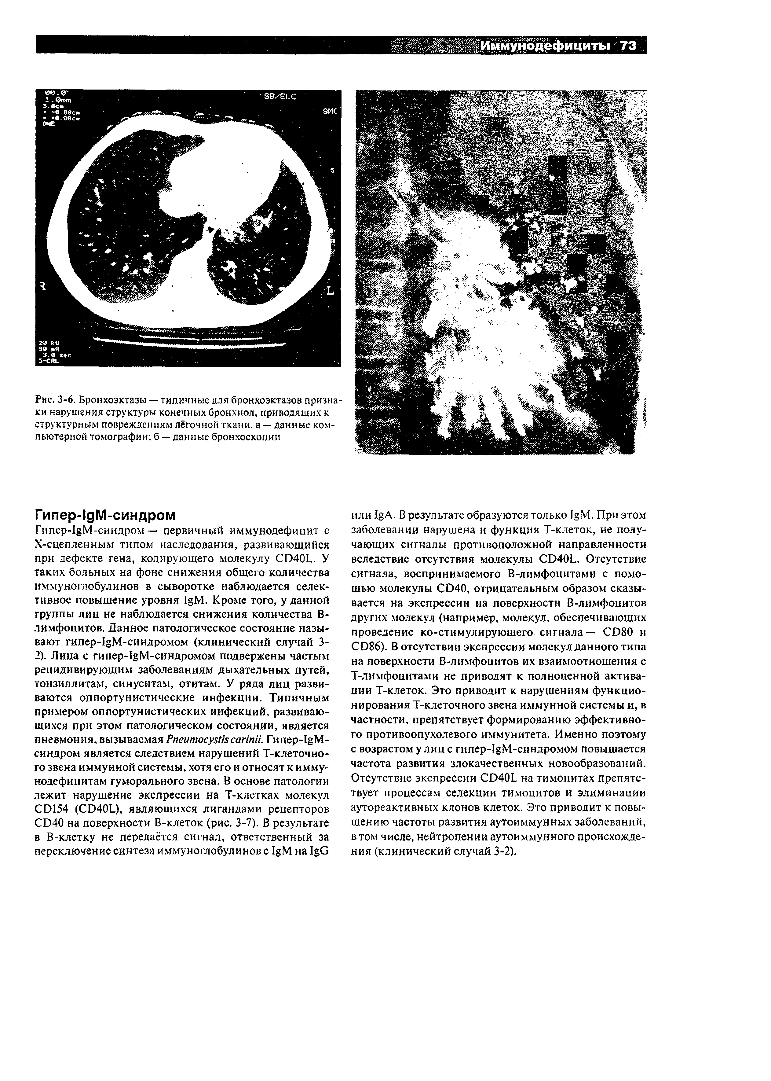 Рис. 3-6. Бронхоэктазы — типичные для бронхоэктазов признаки нарушения структуры конечных бронхиол, приводящих к структурным повреждениям лёгочной ткани, а — данные компьютерной томографии б — данные бронхоскопии...