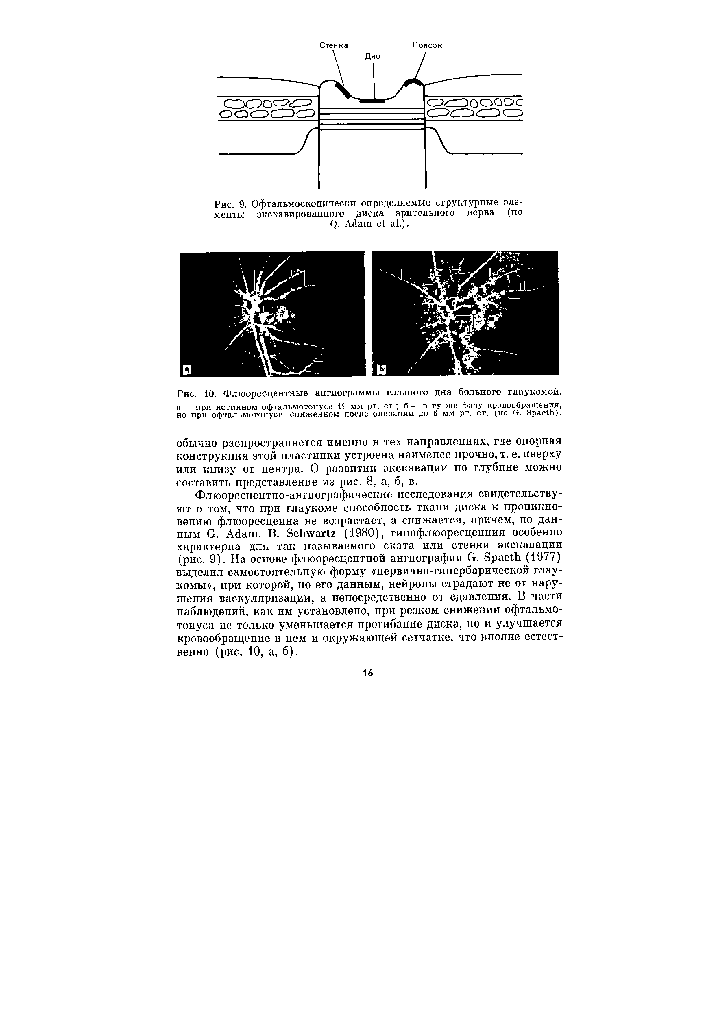 Рис. 10. Флюоресцентные ангиограммы глазного дна больного глаукомой, а — при истинном офтальмотонусе 19 мм рт. ст. б — в ту же фазу кровообращения, но при офтальмотонусе, сниженном после операции до 6 мм рт. ст. (по G. S ).