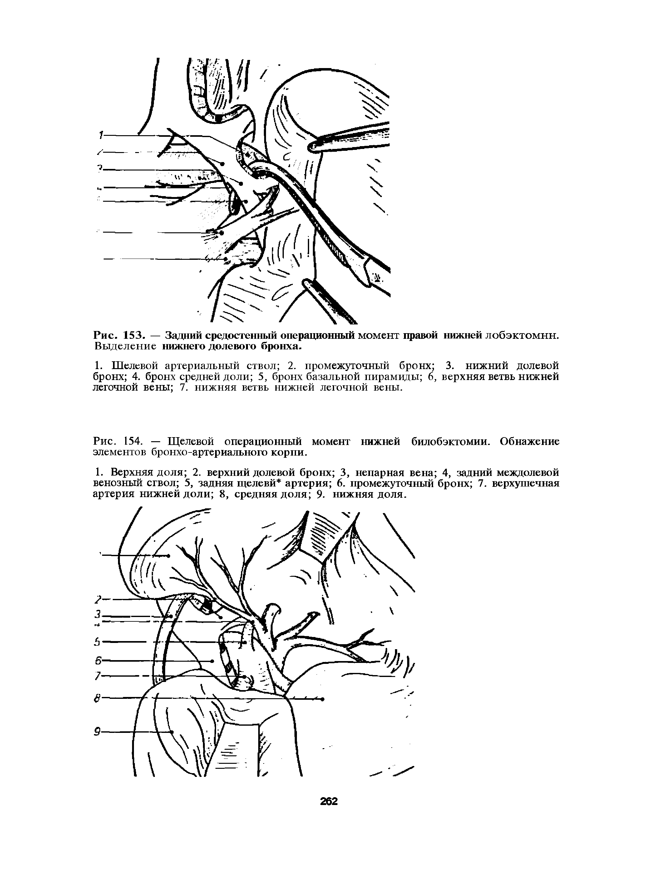 Рис. 154. — Щелевой операционный момент нижней билобэктомии. Обнажение элементов бронхо-артериального корпи.