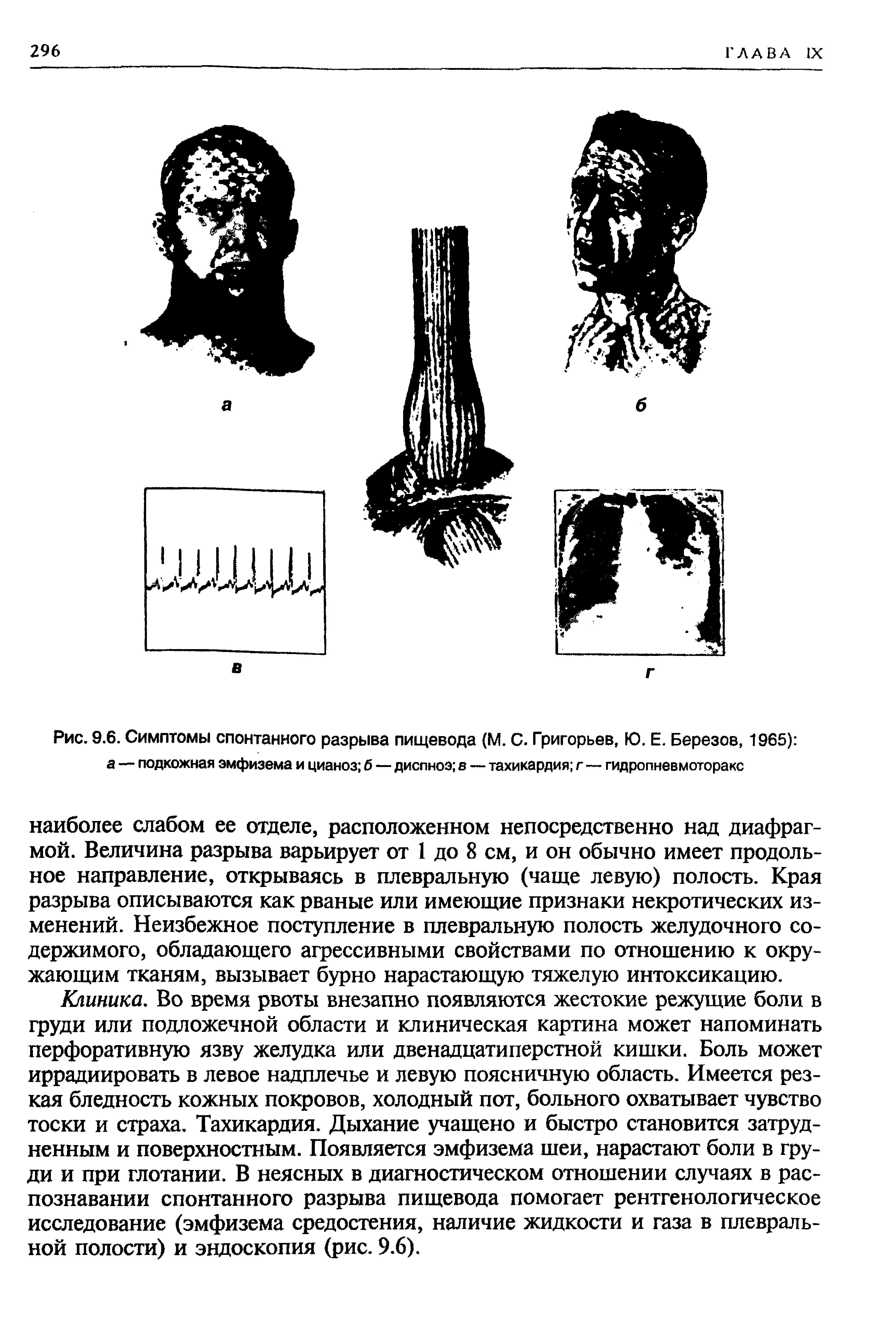 Рис. 9.6. Симптомы спонтанного разрыва пищевода (М. С. Григорьев, Ю. Е. Березов, 1965) а — подкожная эмфизема и цианоз б — диспноэ в — тахикардия г — гидропневмоторакс...