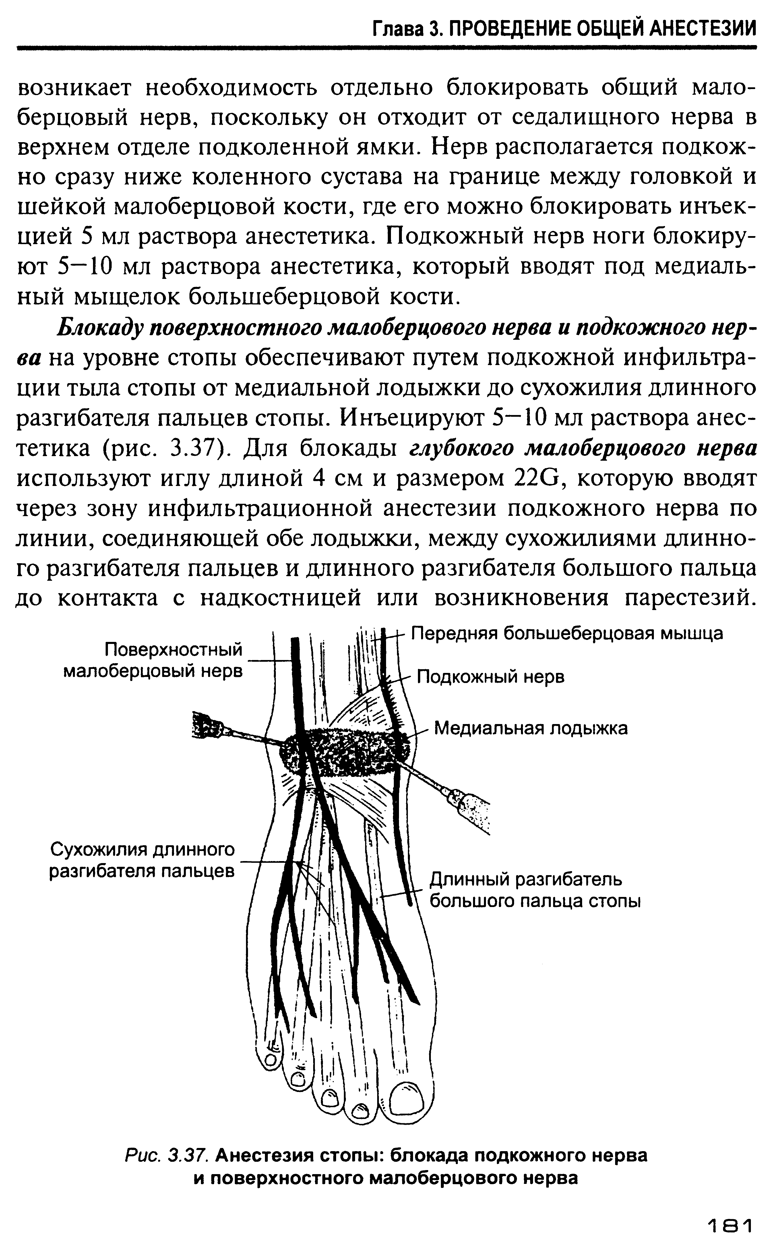 Рис. 3.37. Анестезия стопы блокада подкожного нерва и поверхностного малоберцового нерва...