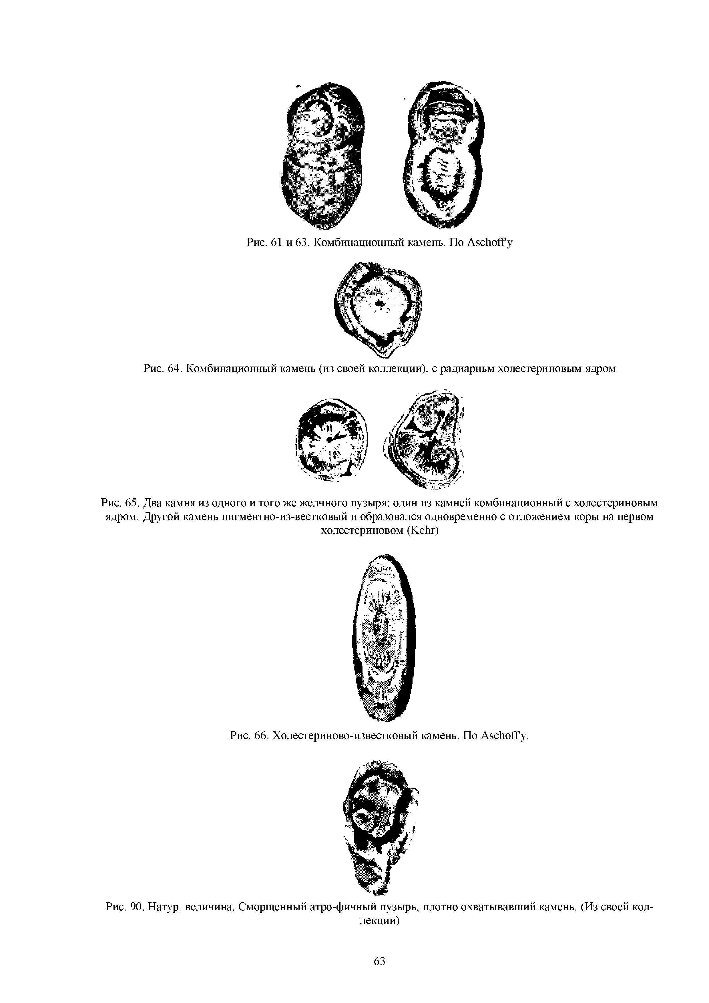 Рис. 65. Два камня из одного и того же желчного пузыря один из камней комбинационный с холестериновым ядром. Другой камень пигментно-из-вестковый и образовался одновременно с отложением коры на первом холестериновом (КеЬг)...