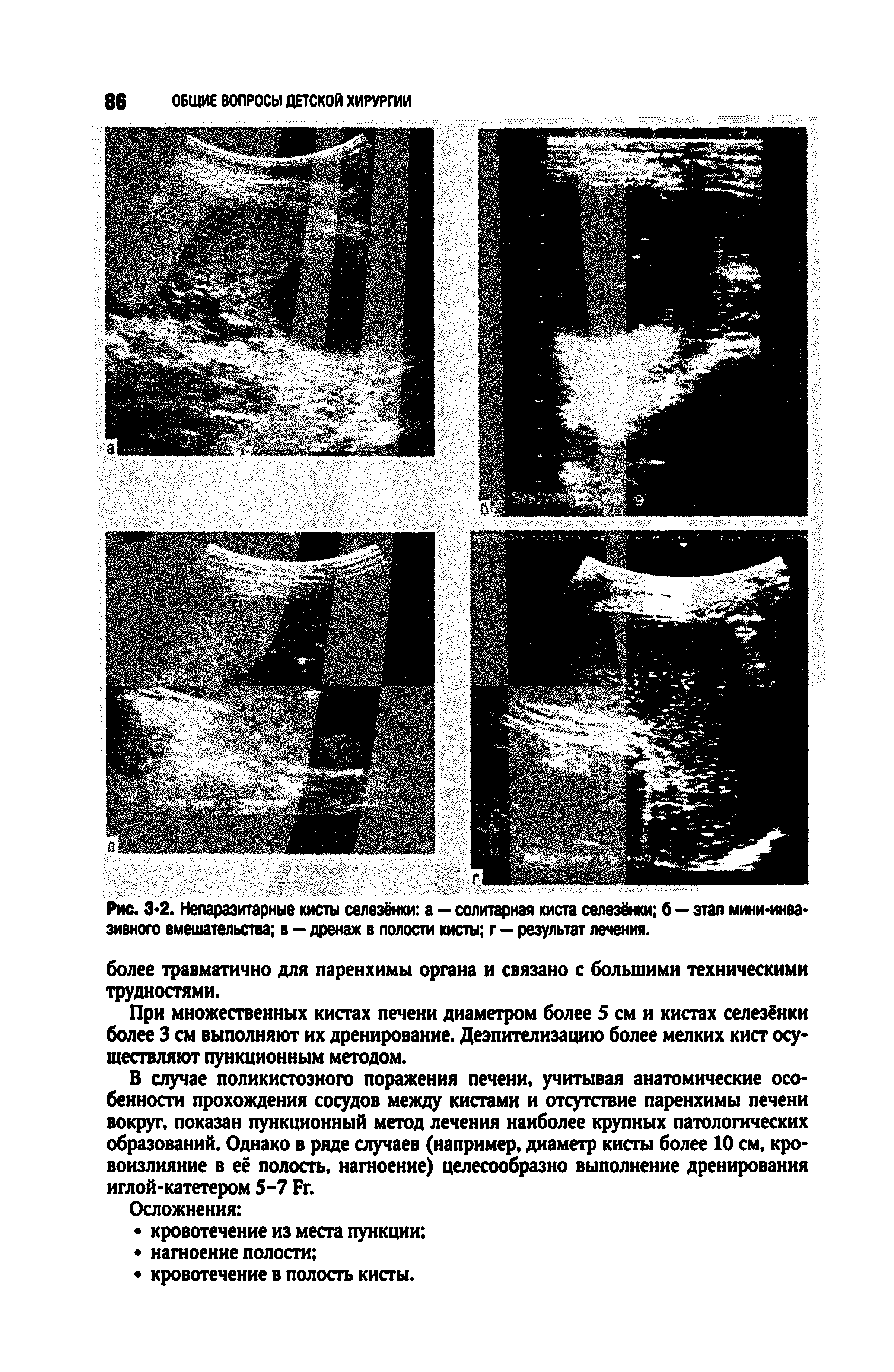 Рис. 3-2. Непаразитарные кисты селезёнки а — солитарная киста селезёнки б — этап мини-инва-зивного вмешательства в - дренаж в полости кисты г — результат лечения.