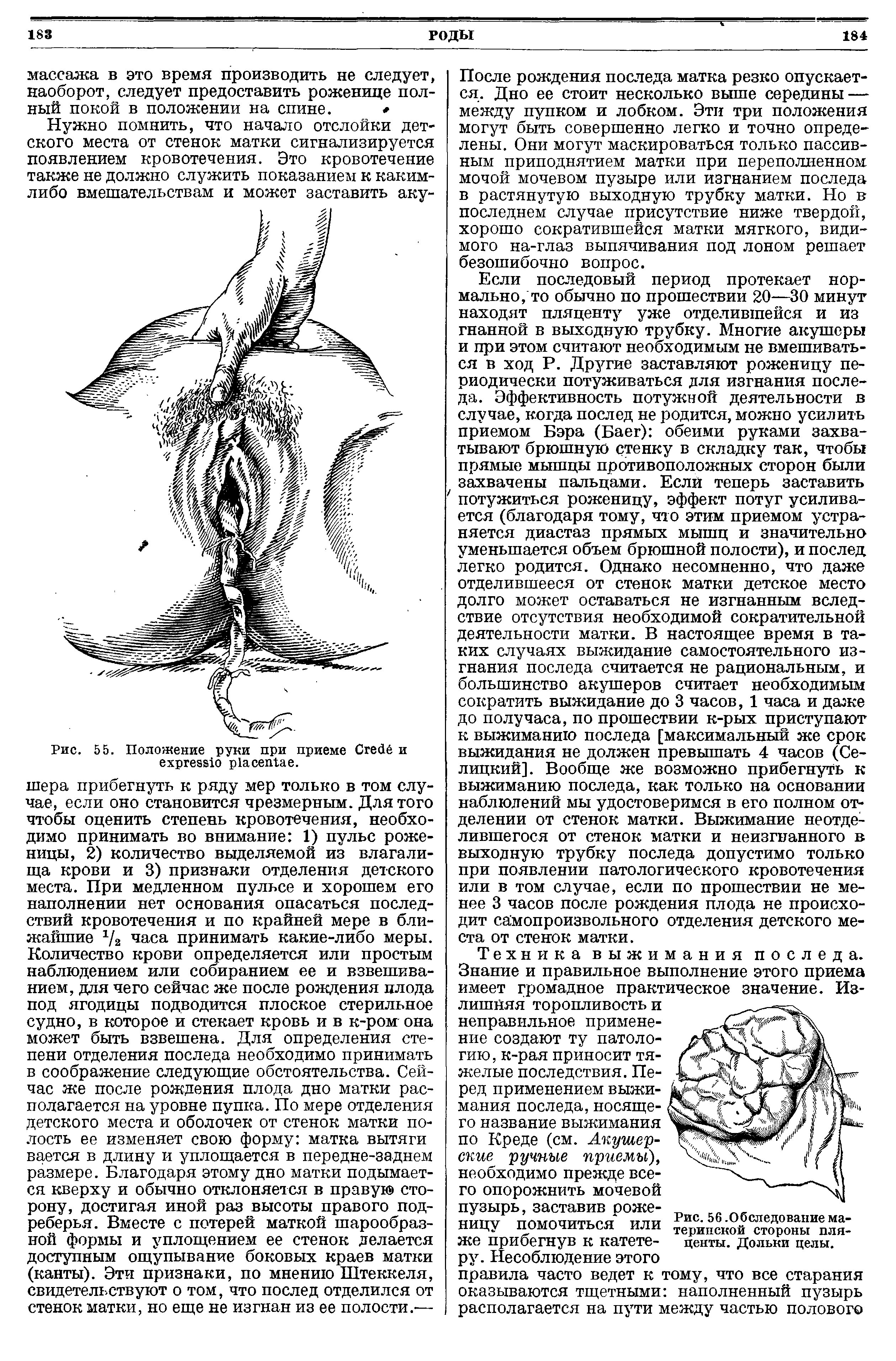 Рис. 56. Обследование материнской стороны плаценты. Дольки целы.