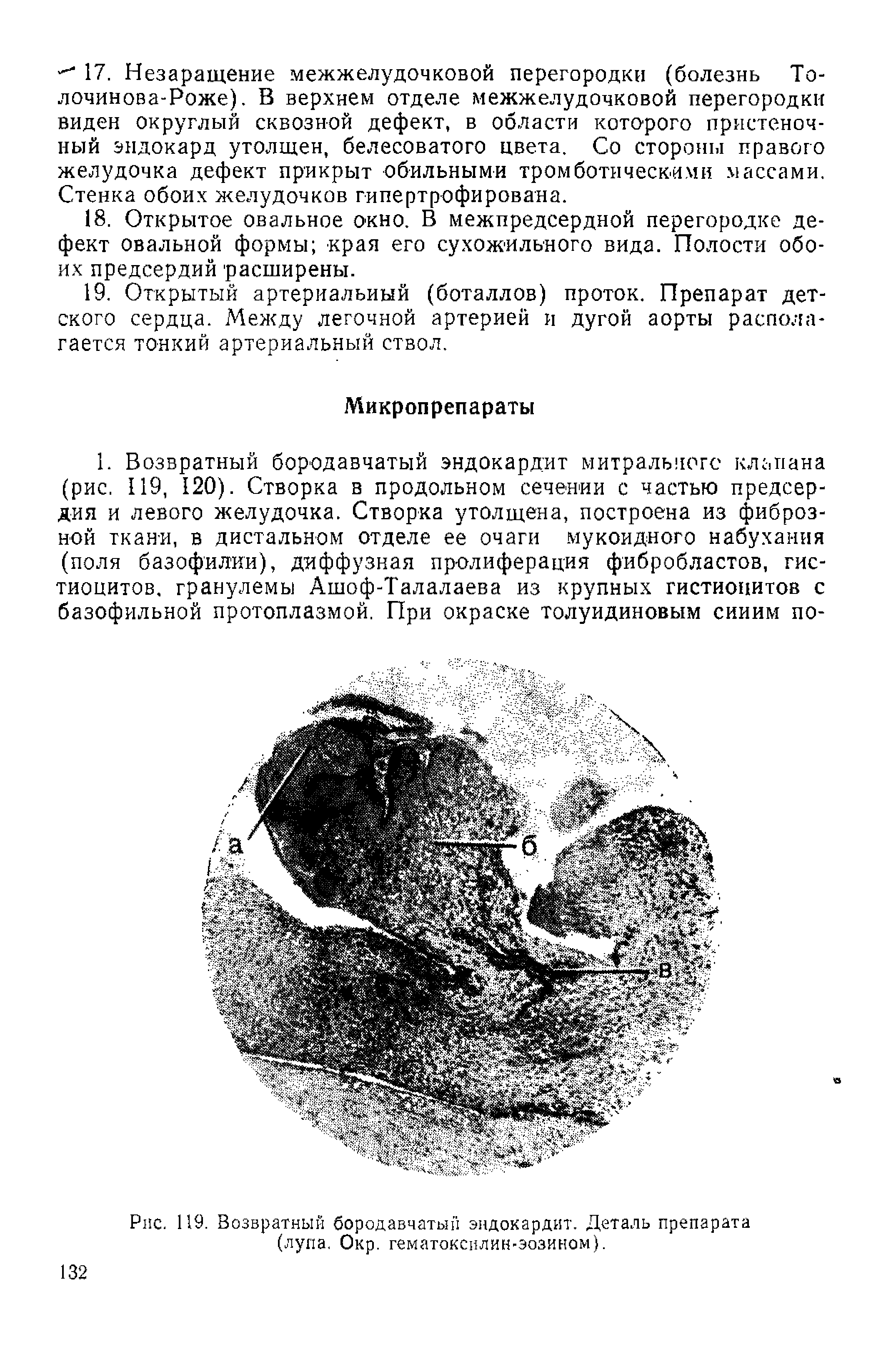 Рис. 119. Возвратный бородавчатый эндокардит. Деталь препарата (лупа. Окр. гематоксилин-эозином).