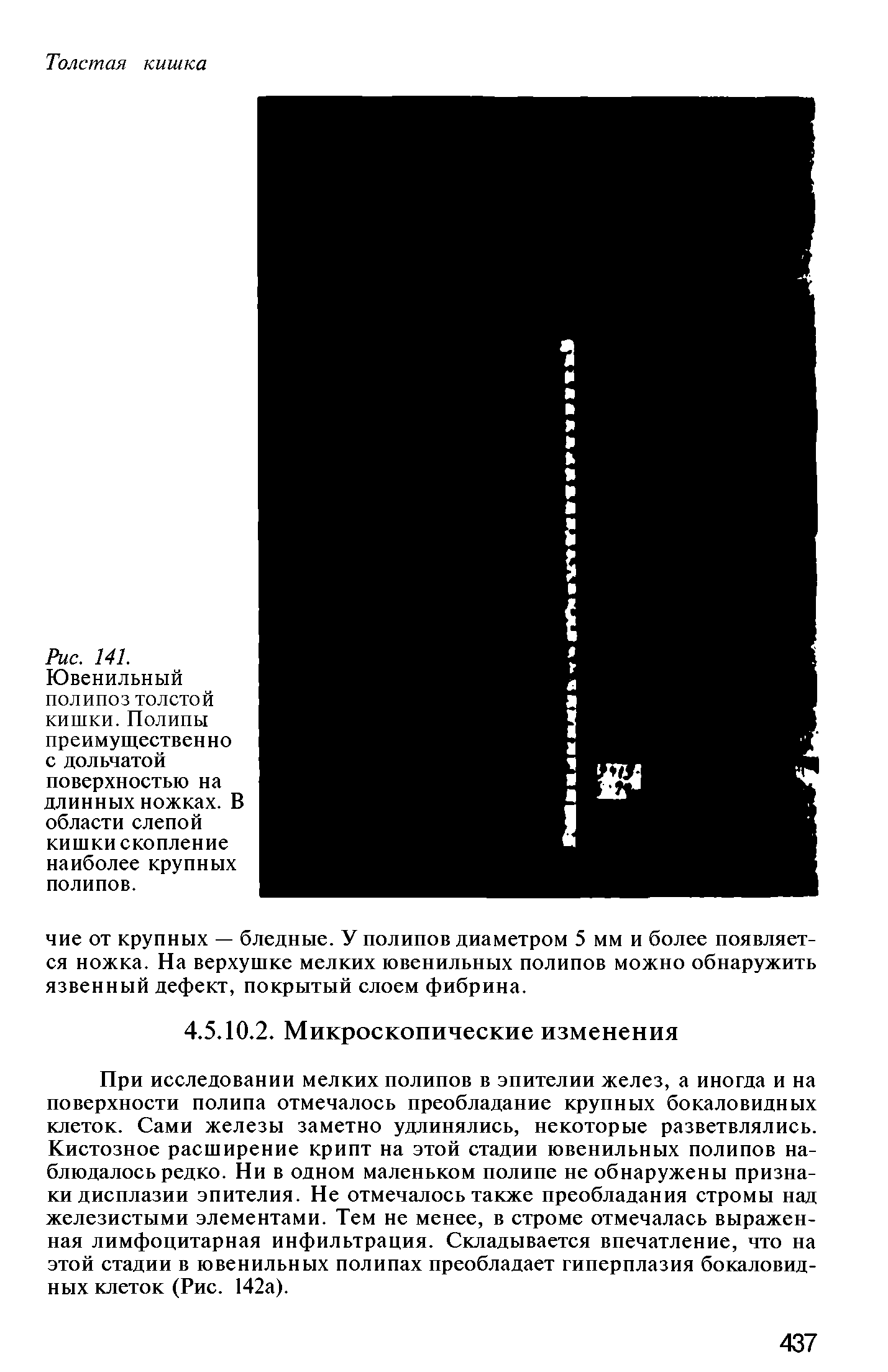 Рис. 141. Ювенильный полипоз толстой кишки. Полипы преимуществен но с дольчатой поверхностью на длинных ножках. В области слепой кишки скопление наиболее крупных полипов.