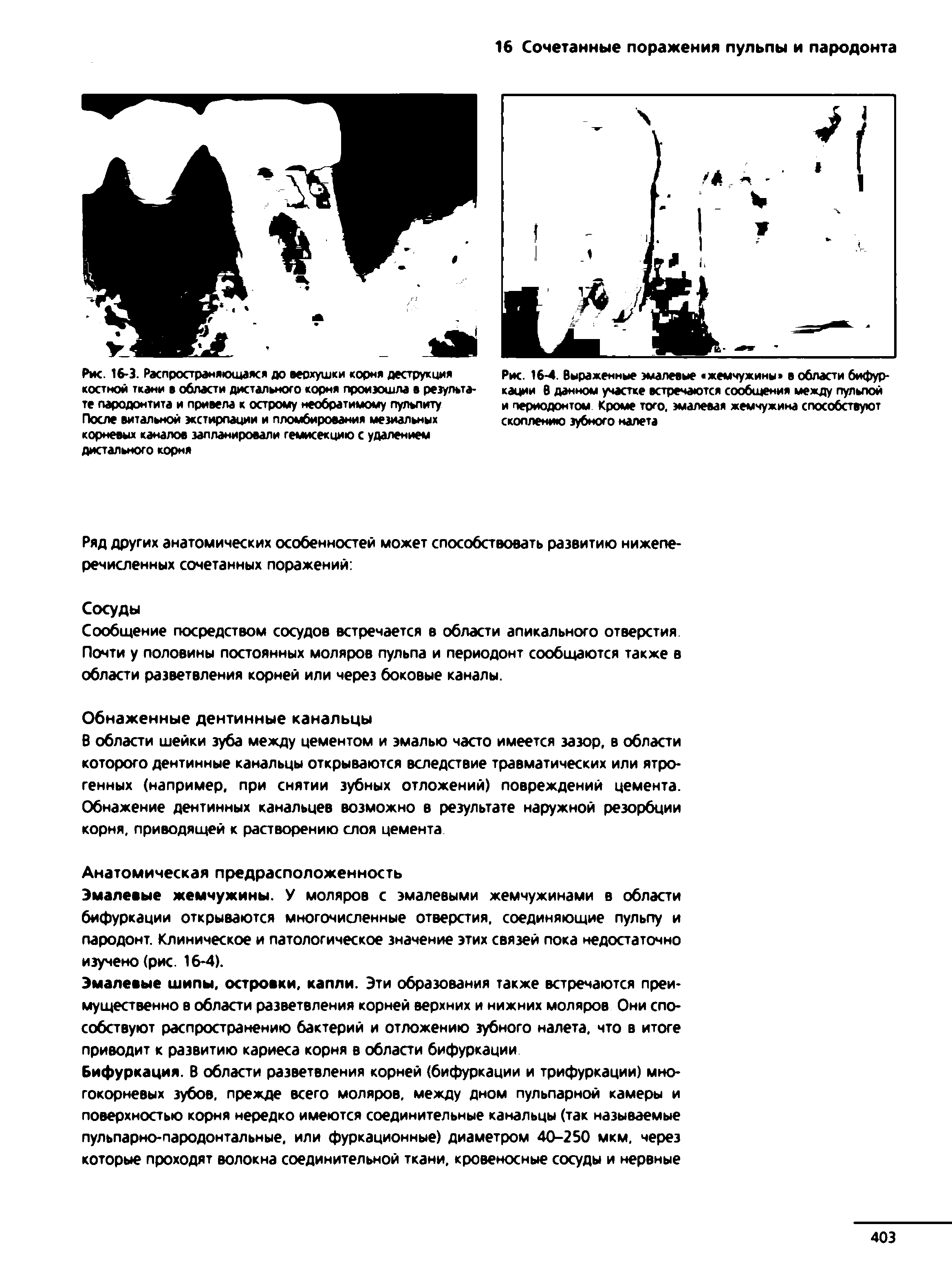 Рис. 16-4. Выраженные эмалевые жемчужины в области бифуркации В данном участке встречаются сообщения между пульпой и периодонтом Кроме того, эмалевая жемчужина способствуют скоплению зубного налета...