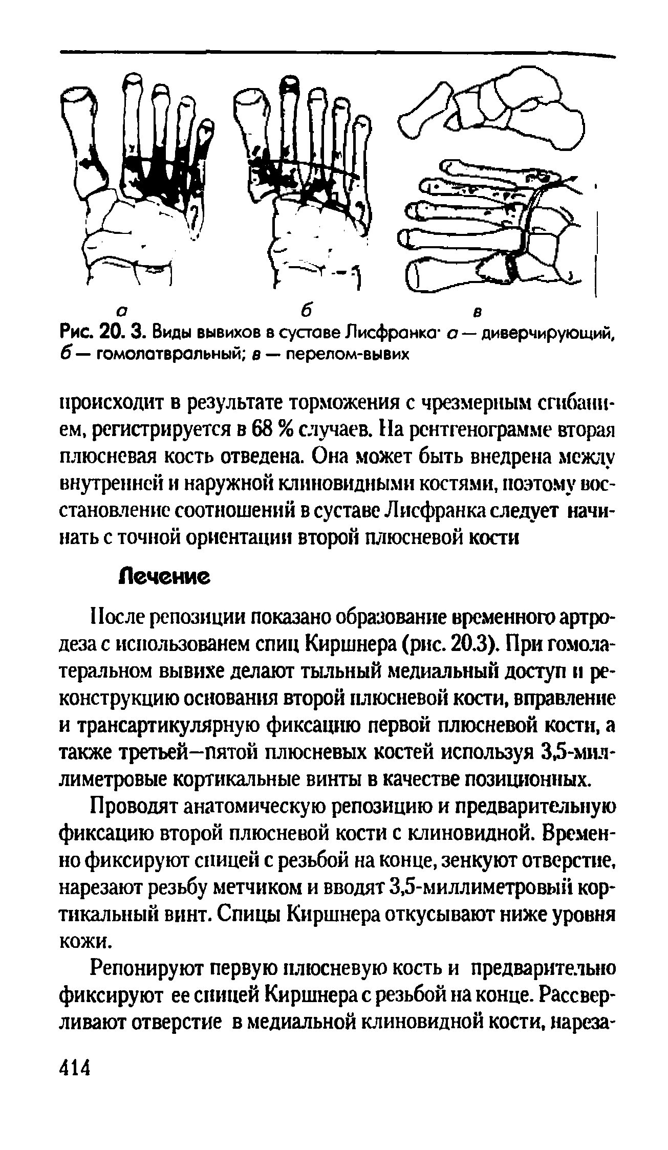 Рис. 20. 3. Виды вывихов в суставе Лисфранка а — диверчирующий, б — гомолатвральный в — перелом-вывих...