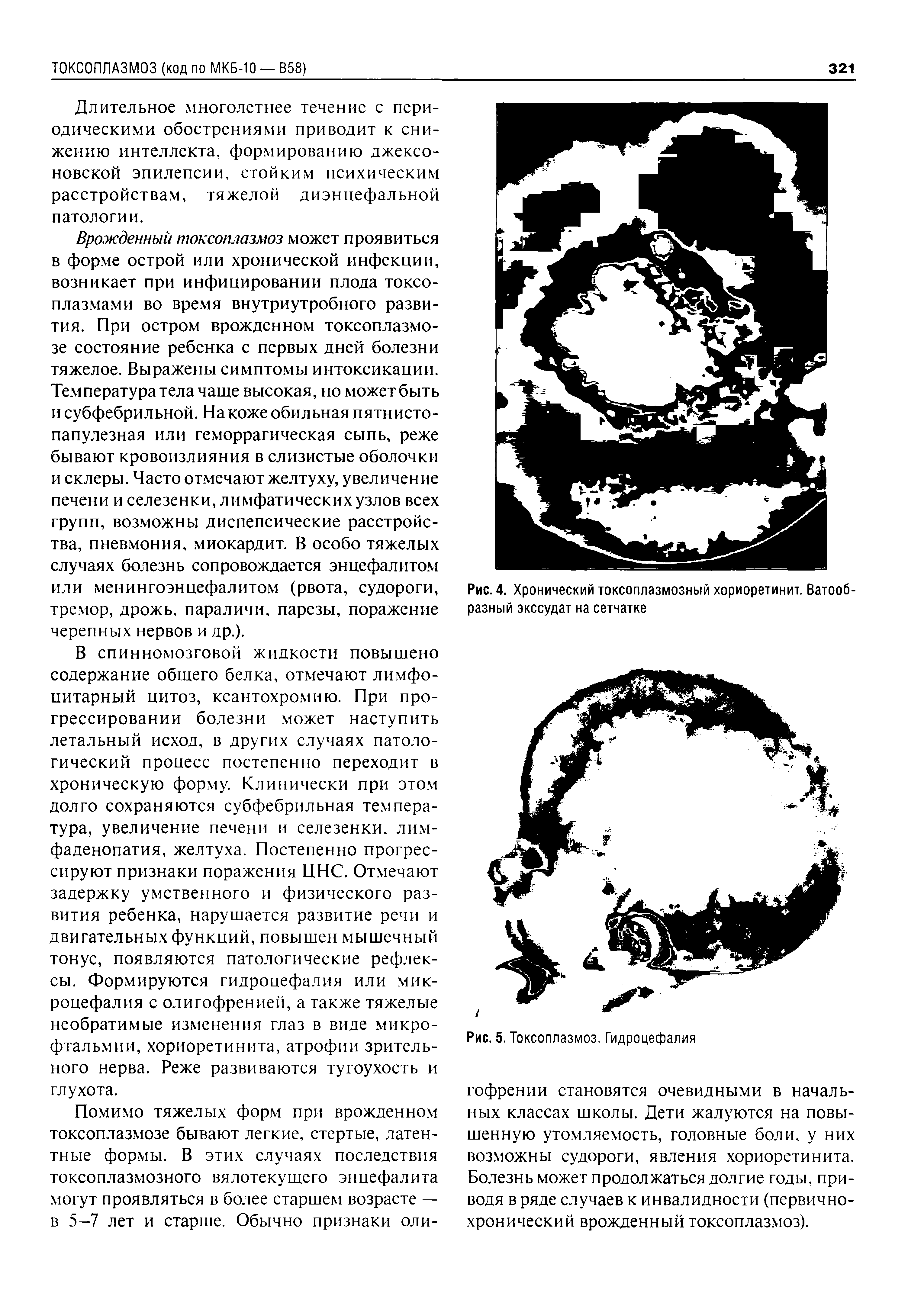 Рис. 4. Хронический токсоплазмозный хориоретинит. Ватообразный экссудат на сетчатке...