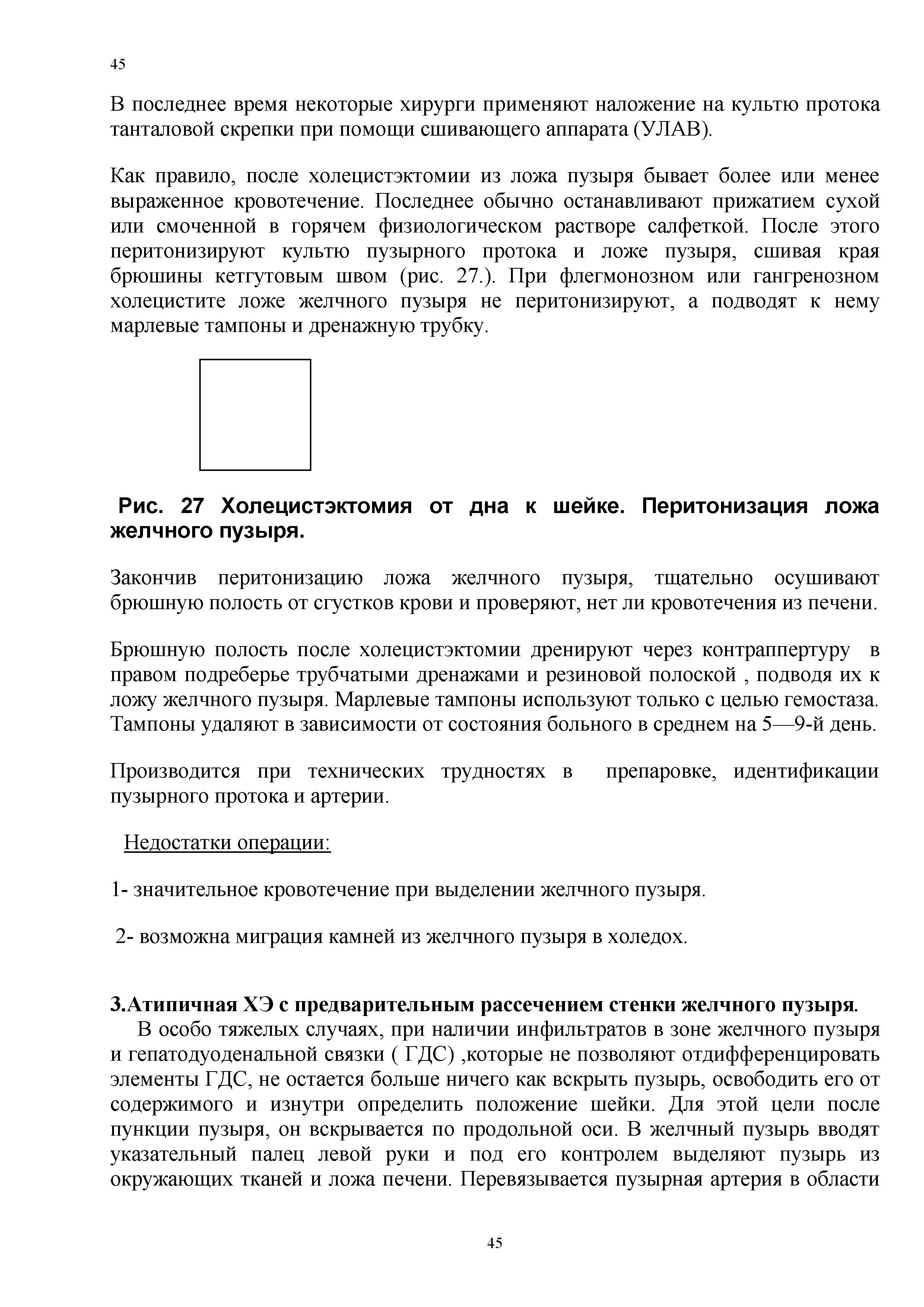 Рис. 27 Холецистэктомия от дна к шейке. Перитонизация ложа желчного пузыря.