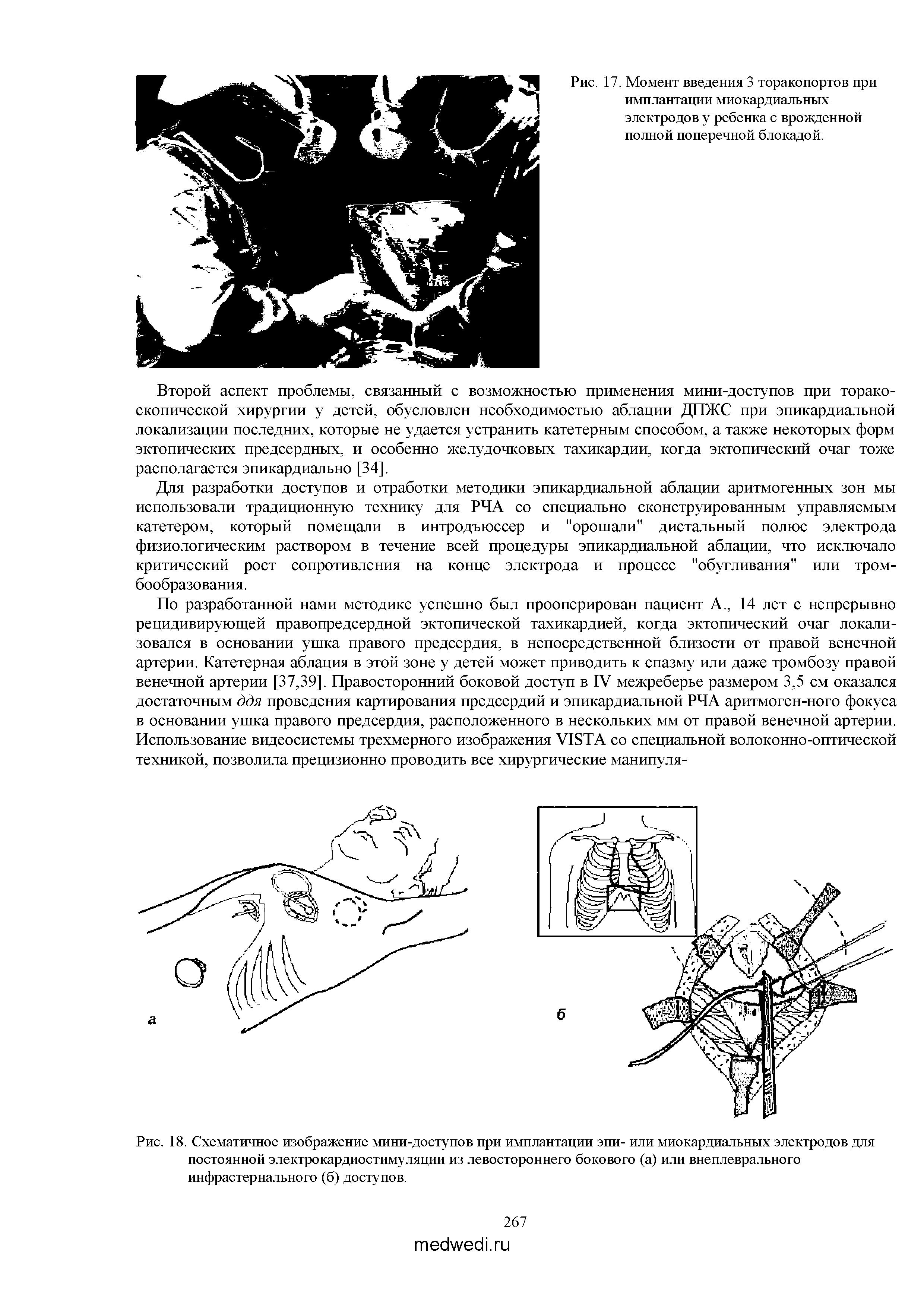 Рис. 18. Схематичное изображение мини-доступов при имплантации эпи- или миокардиальных электродов для постоянной электрокардиостимуляции из левостороннего бокового (а) или внеплеврального инфрастернального (б) доступов.