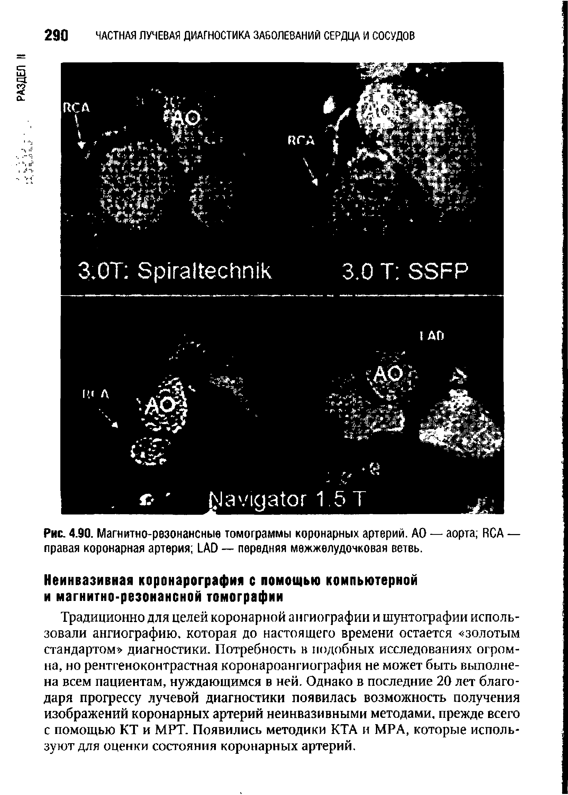 Рис. 4.90. Магнитно-резонансные томограммы коронарных артерий. АО — аорта RCA — правая коронарная артерия LAD — передняя межжелудочковая ветвь.