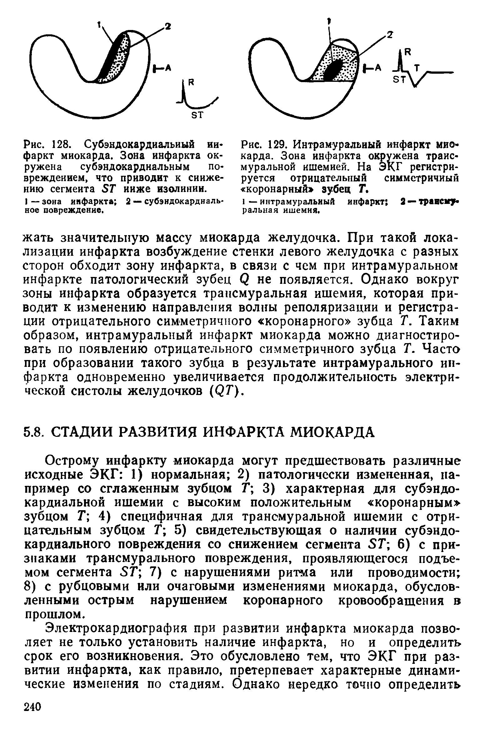 Рис. 129. Интрамуральный инфаркт миокарда. Зона инфаркта окружена трансмуральной ишемией. На ЭКГ регистрируется отрицательный симметричный коронарный зубец Т.