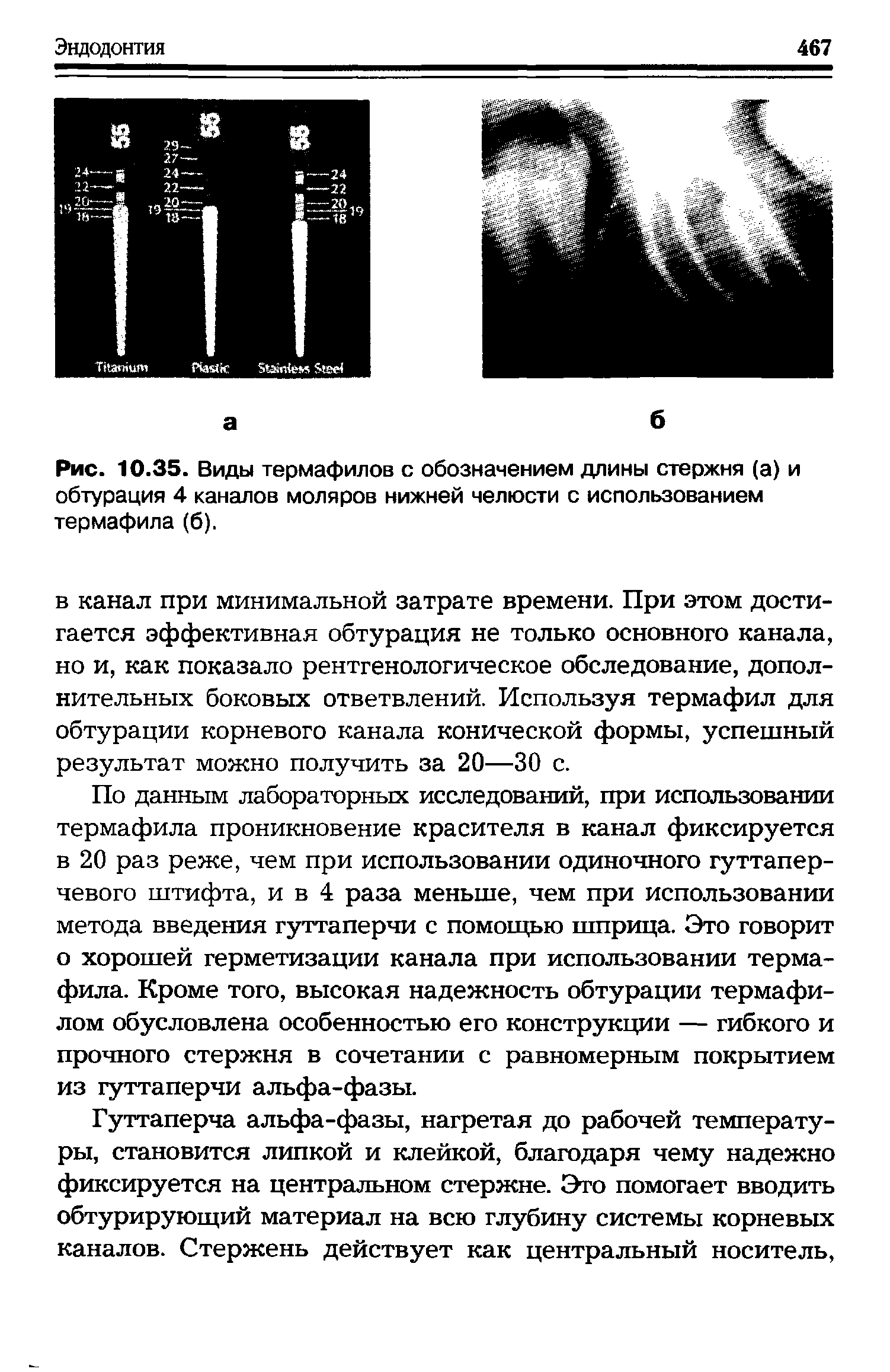 Рис. 10.35. Виды термафилов с обозначением длины стержня (а) и обтурация 4 каналов моляров нижней челюсти с использованием термафила (б).