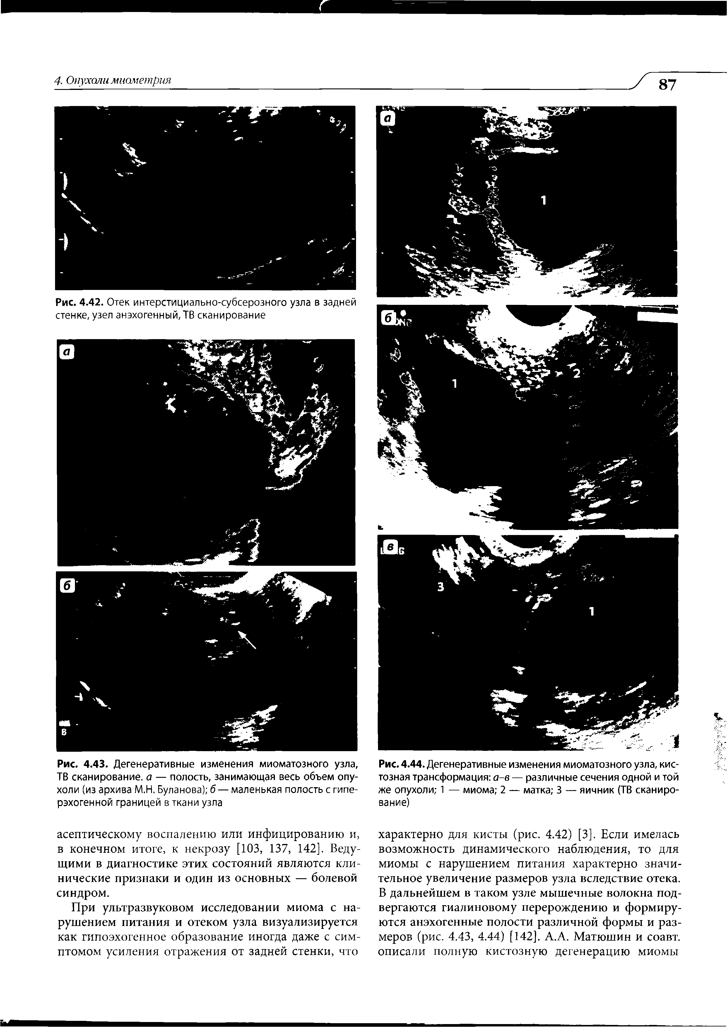 Рис. 4.43. Дегенеративные изменения миоматозного узла, ТВ сканирование, а — полость, занимающая весь объем опухоли (из архива М.Н. Буланова) б— маленькая полость с гиперэхогенной границей в ткани узла...