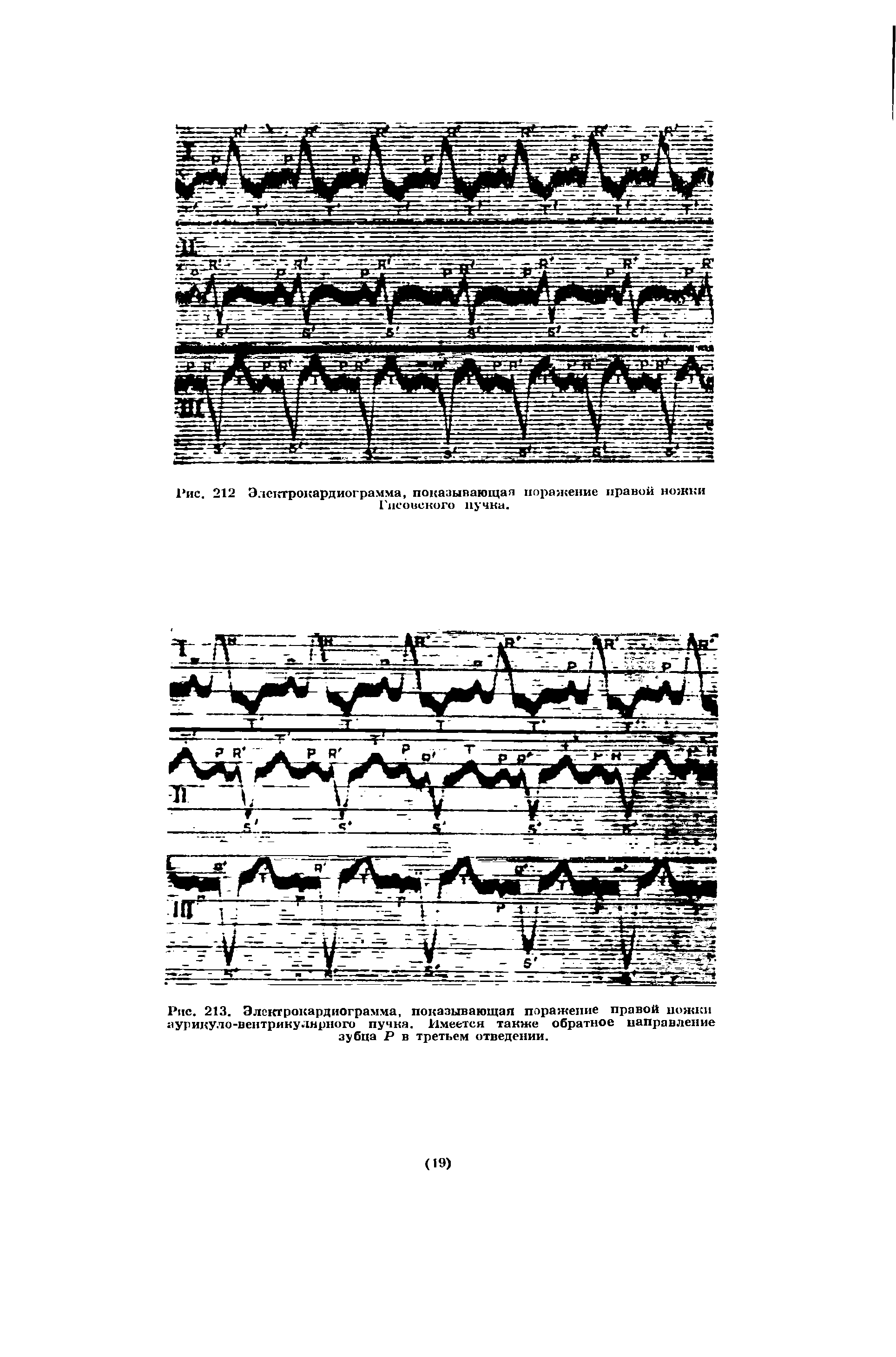 Рис. 213. Электрокардиограмма, показывающая поражение правой пожни аурикуло-вентрикуднрного пучка. Имеется также обратное направление зубца Р в третьем отведении.