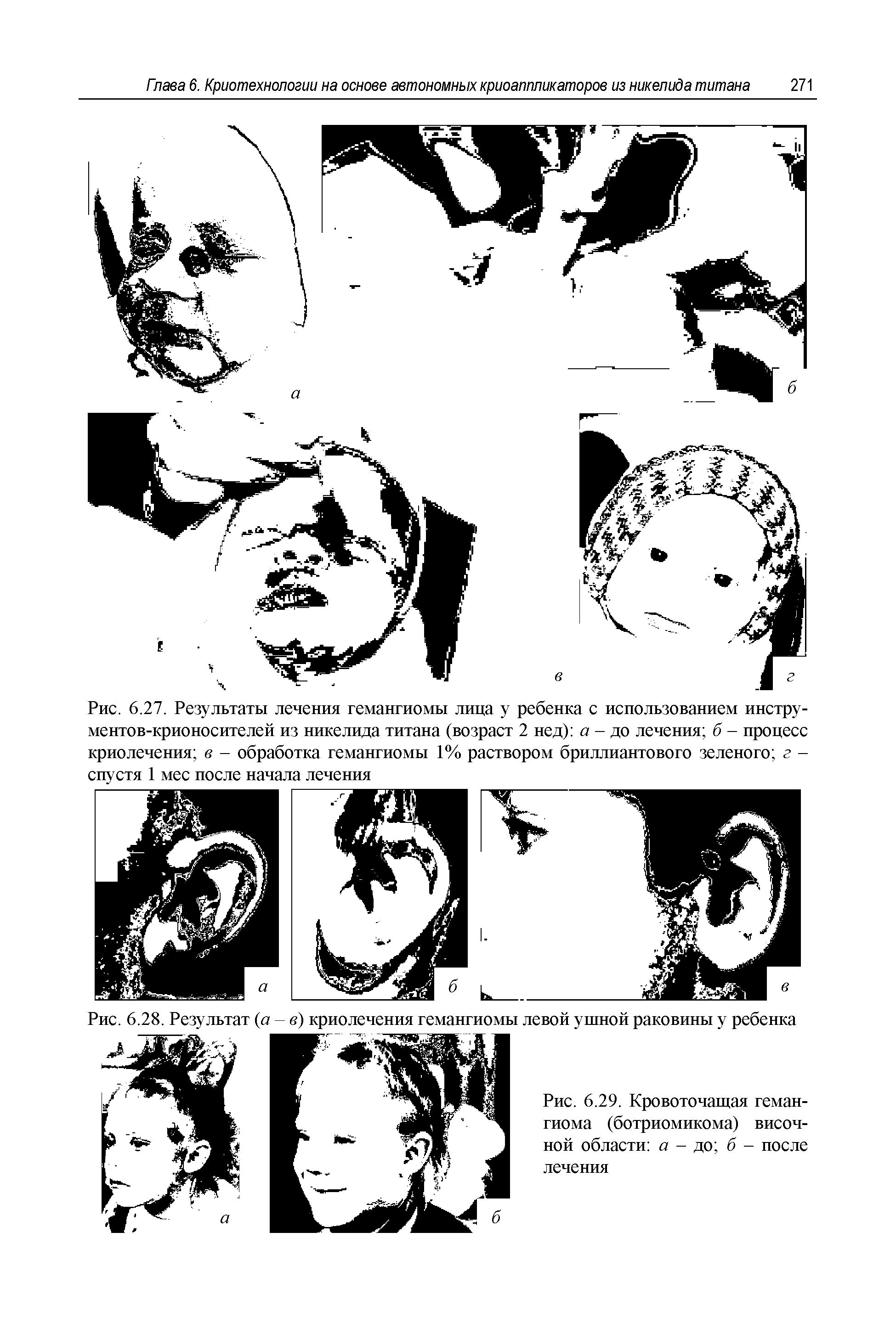 Рис. 6.29. Кровоточащая гемангиома (ботриомикома) височной области а - до б - после лечения...