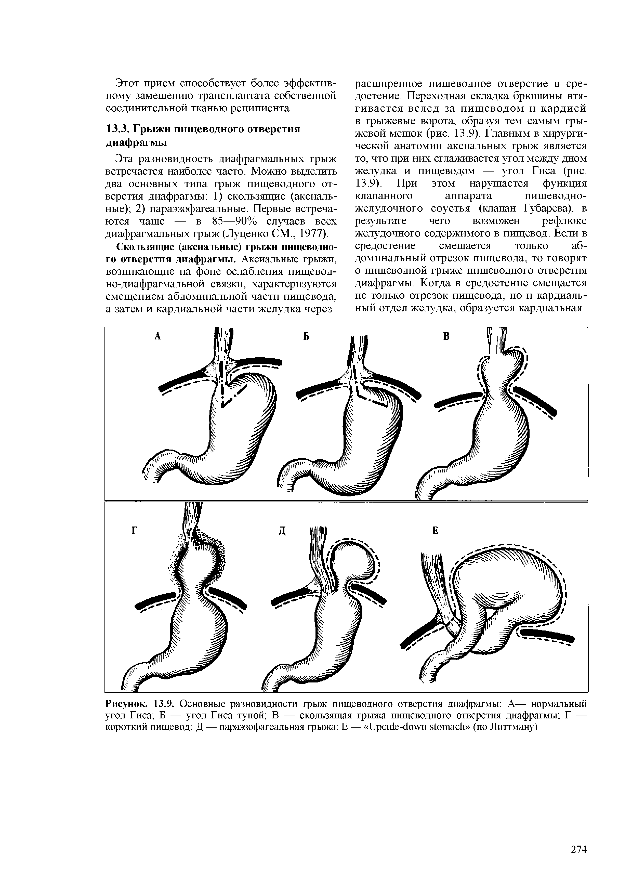 Рисунок. 13.9. Основные разновидности грыж пищеводного отверстия диафрагмы А— нормальный угол Гиса Б — угол Гиса тупой В — скользящая грыжа пищеводного отверстия диафрагмы Г — короткий пищевод Д — параэзофагеальная грыжа Е — ирс1с1с-с1о п вЩшасй (по Диттману)...