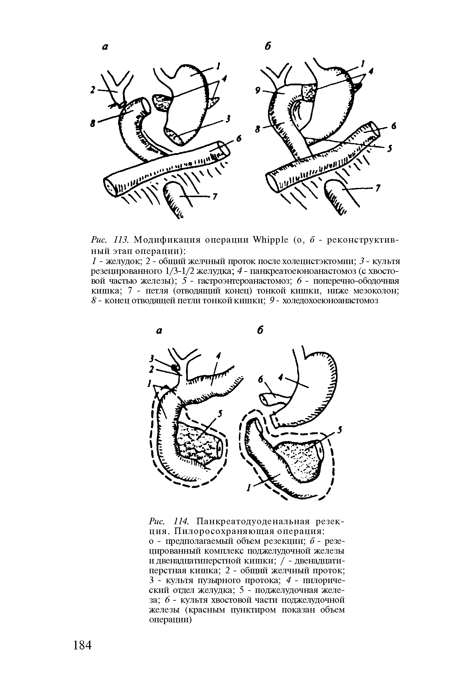 Рис. 114. Панкреатодуоденальная резекция. Пилоросохраняющая операция о - предполагаемый объем резекции б - резецированный комплекс поджелудочной железы и двенадцатиперстной кишки / - двенадцатиперстная кишка 2 - общий желчный проток 3 - культя пузырного протока 4 - пилорический отдел желудка 5 - поджелудочная железа 6 - культя хвостовой части поджелудочной железы (красным пунктиром показан объем операции)...