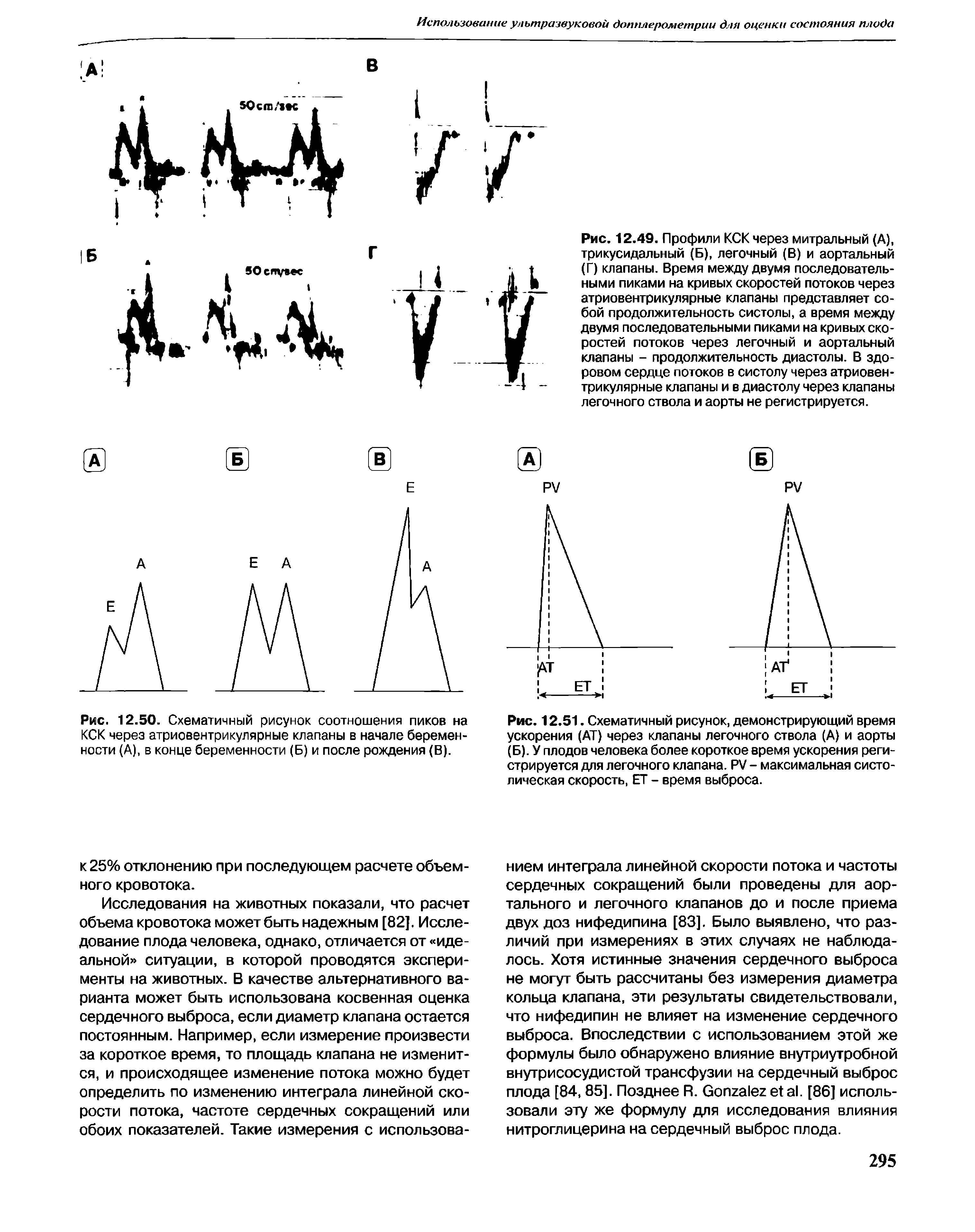 Рис. 12.51. Схематичный рисунок, демонстрирующий время ускорения (АТ) через клапаны легочного ствола (А) и аорты (Б). У плодов человека более короткое время ускорения регистрируется для легочного клапана. РУ - максимальная систолическая скорость, ЕТ - время выброса.