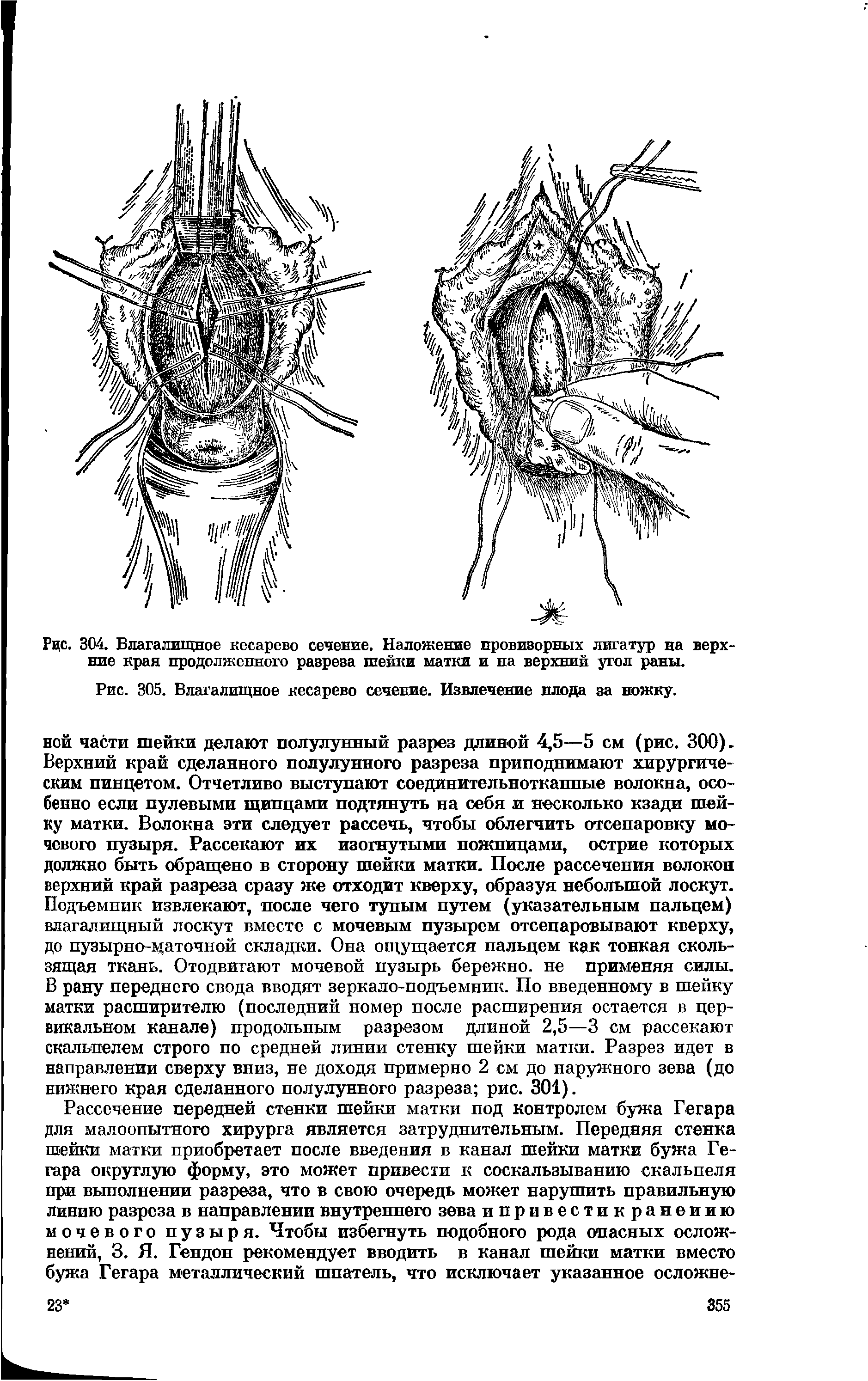 Рис. 305. Влагалищное кесарево сечение. Извлечение плода за ножку.