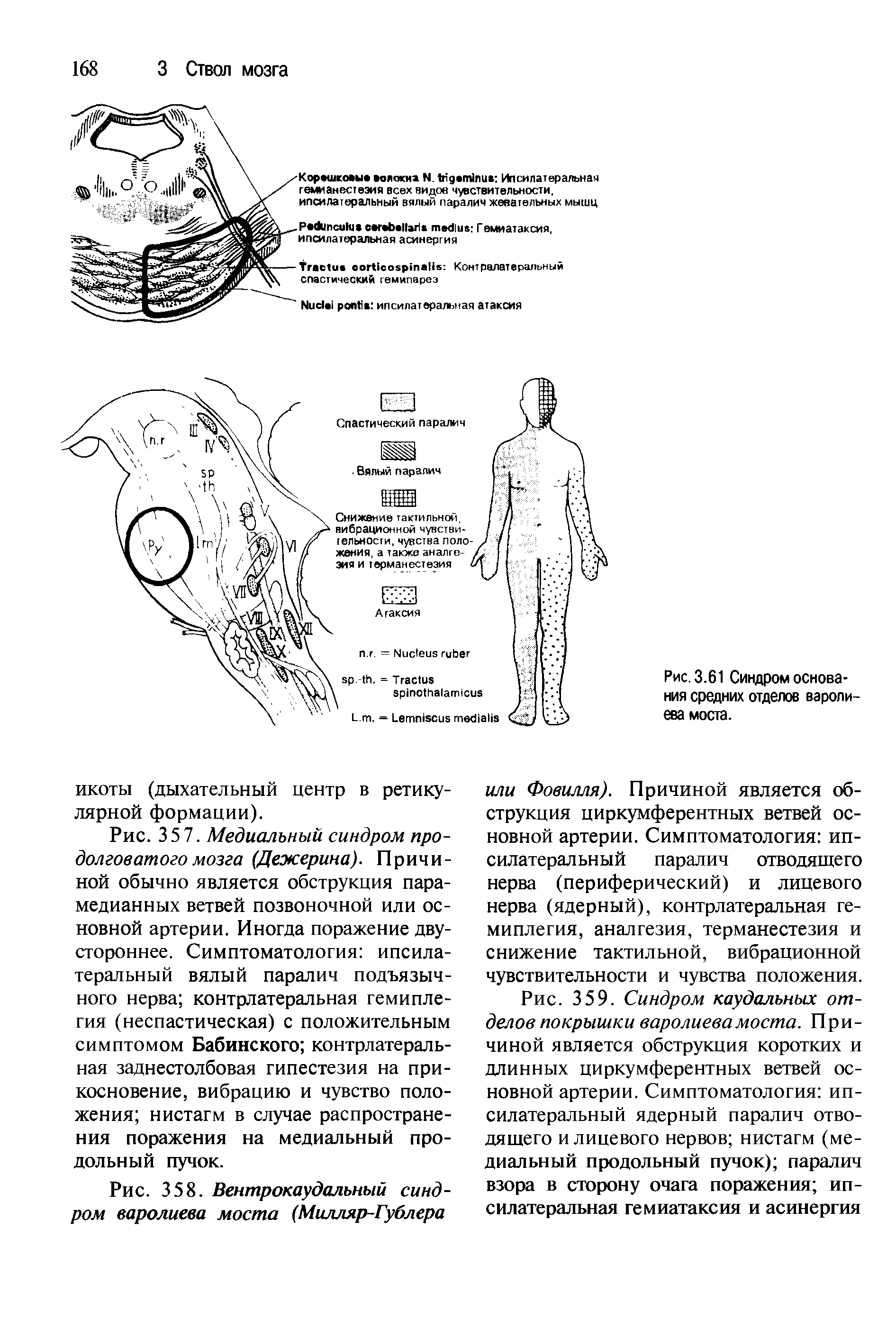 Рис. 358. Вентрокаудальный синдром варолиева моста (Милляр-Гублера...