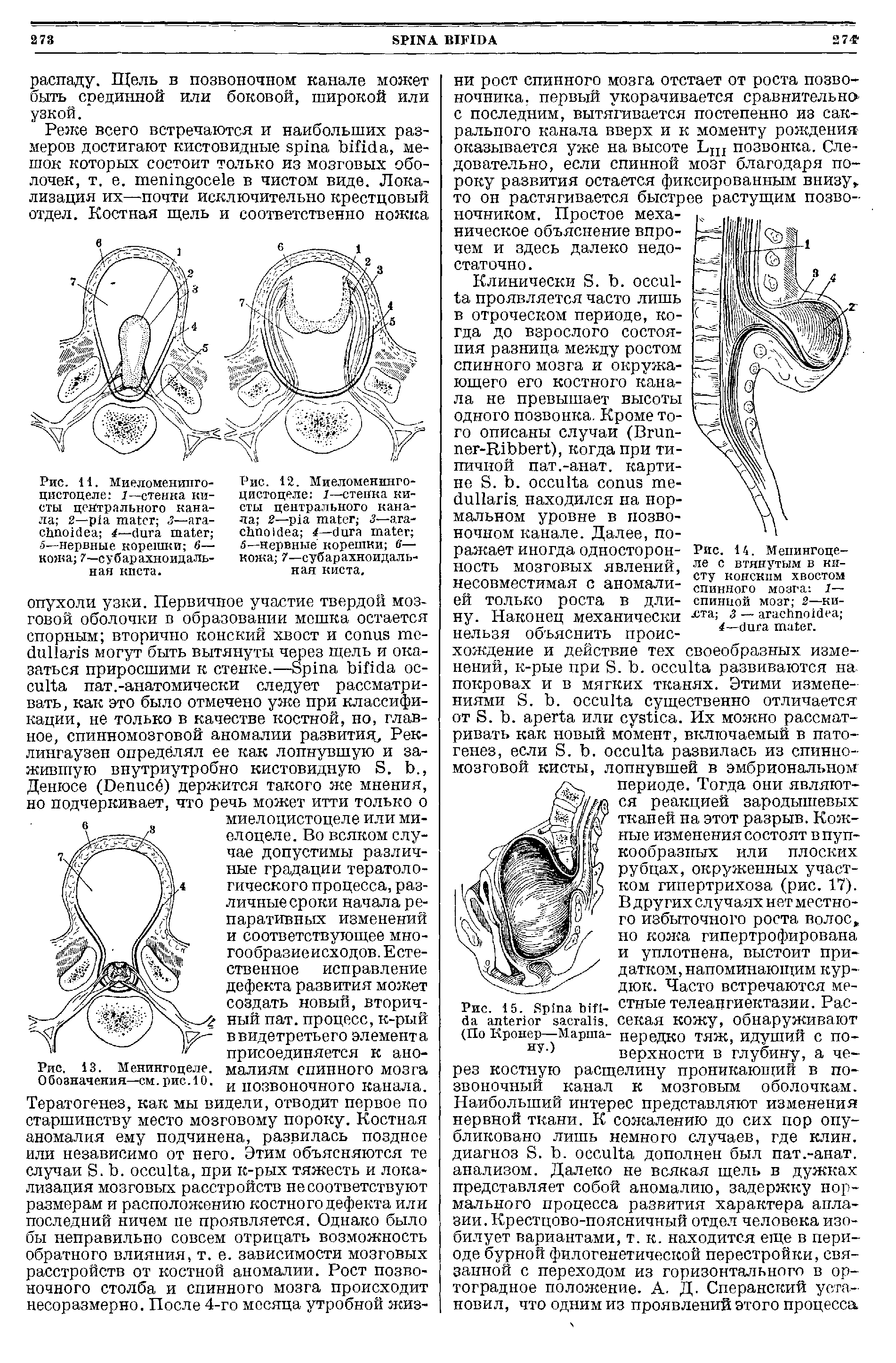 Рис. 14. Менингоцеле с втянутым в кисту конским хвостом спинного мозга 1— спинной мозг 2—ки- CT 3 — ...