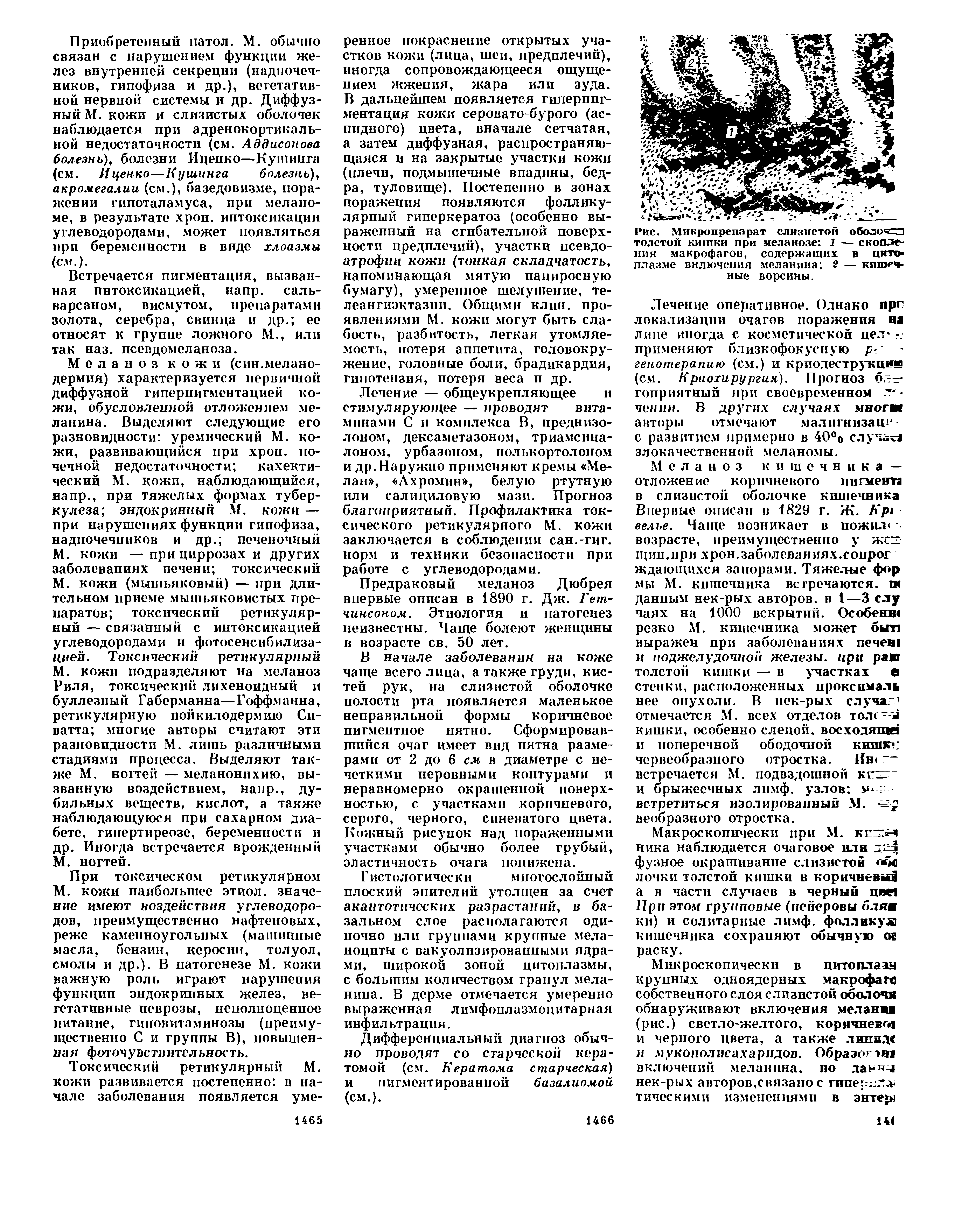 Рис. Микропрепарат слизистой оболоч=21 толстой кишки при меланозе 1 — скопления макрофагов, содержащих в цято-плазме включения меланина 2 — кишечные ворсины.