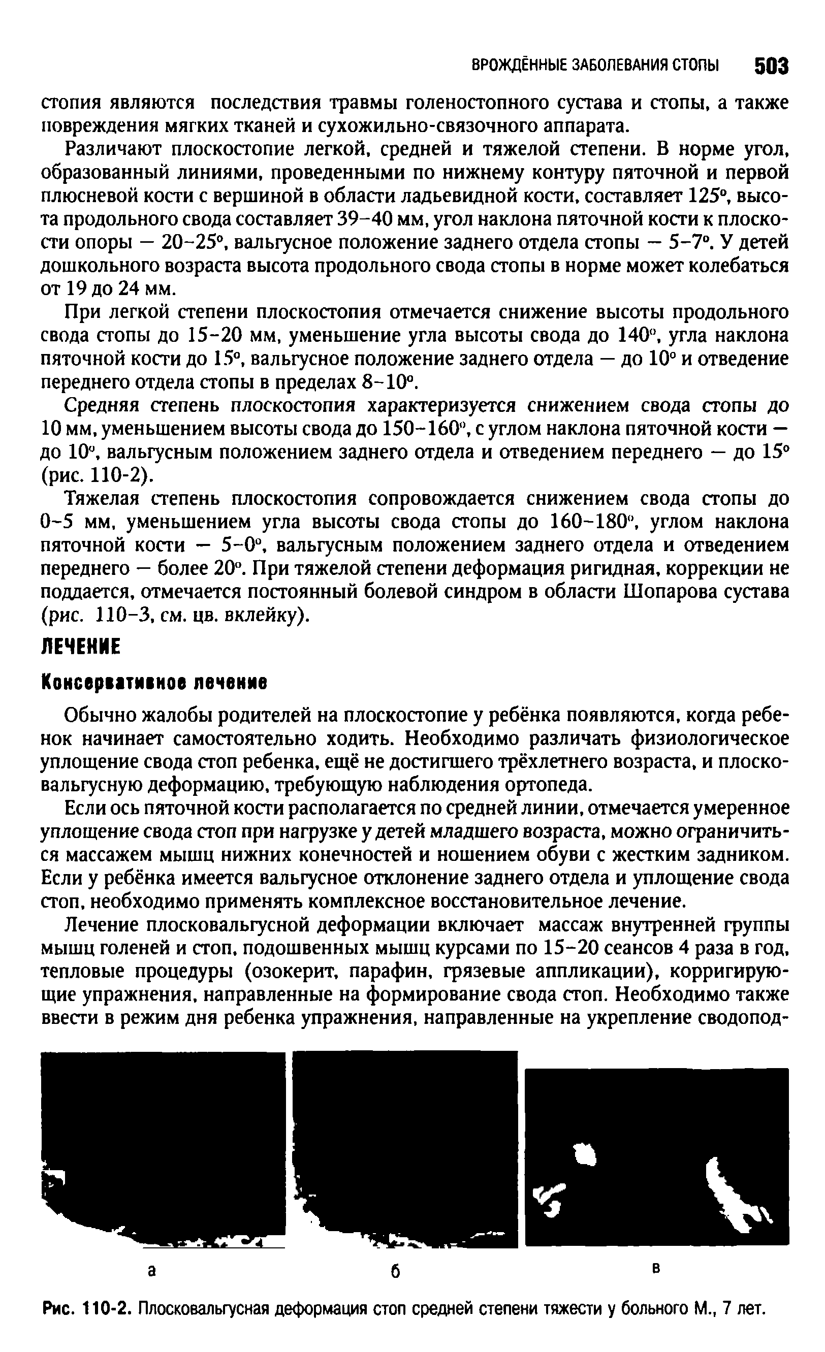 Рис. 110-2. Плосковальгусная деформация стоп средней степени тяжести у больного М., 7 лет.