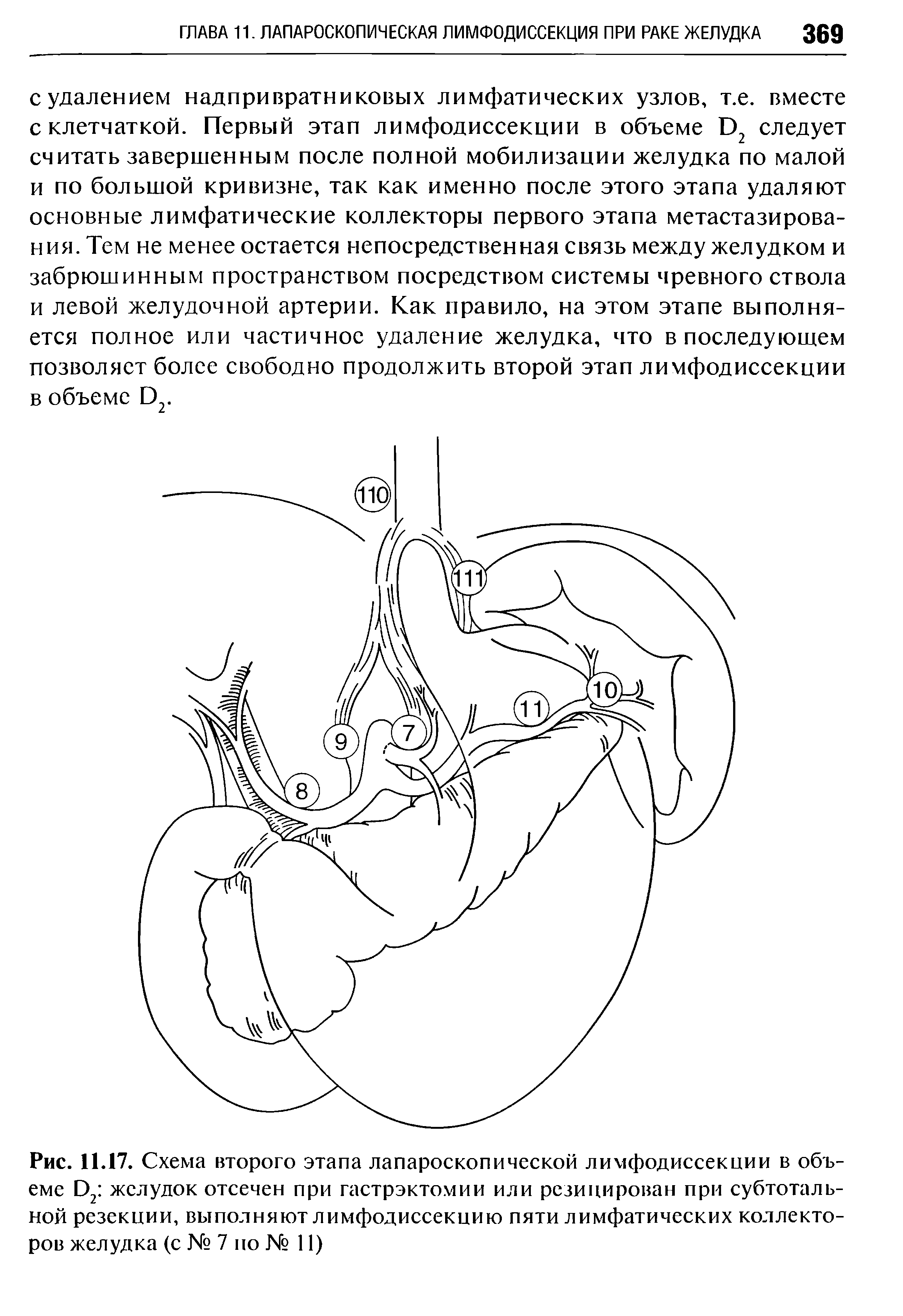 Рис. 11.17. Схема второго этапа лапароскопической лимфодиссекции в объеме Э2 желудок отсечен при гастрэктомии или рсзицирован при субтотальной резекции, выполняют лимфодиссекцию пяти лимфатических коллекторов желудка (с № 7 по № 11)...