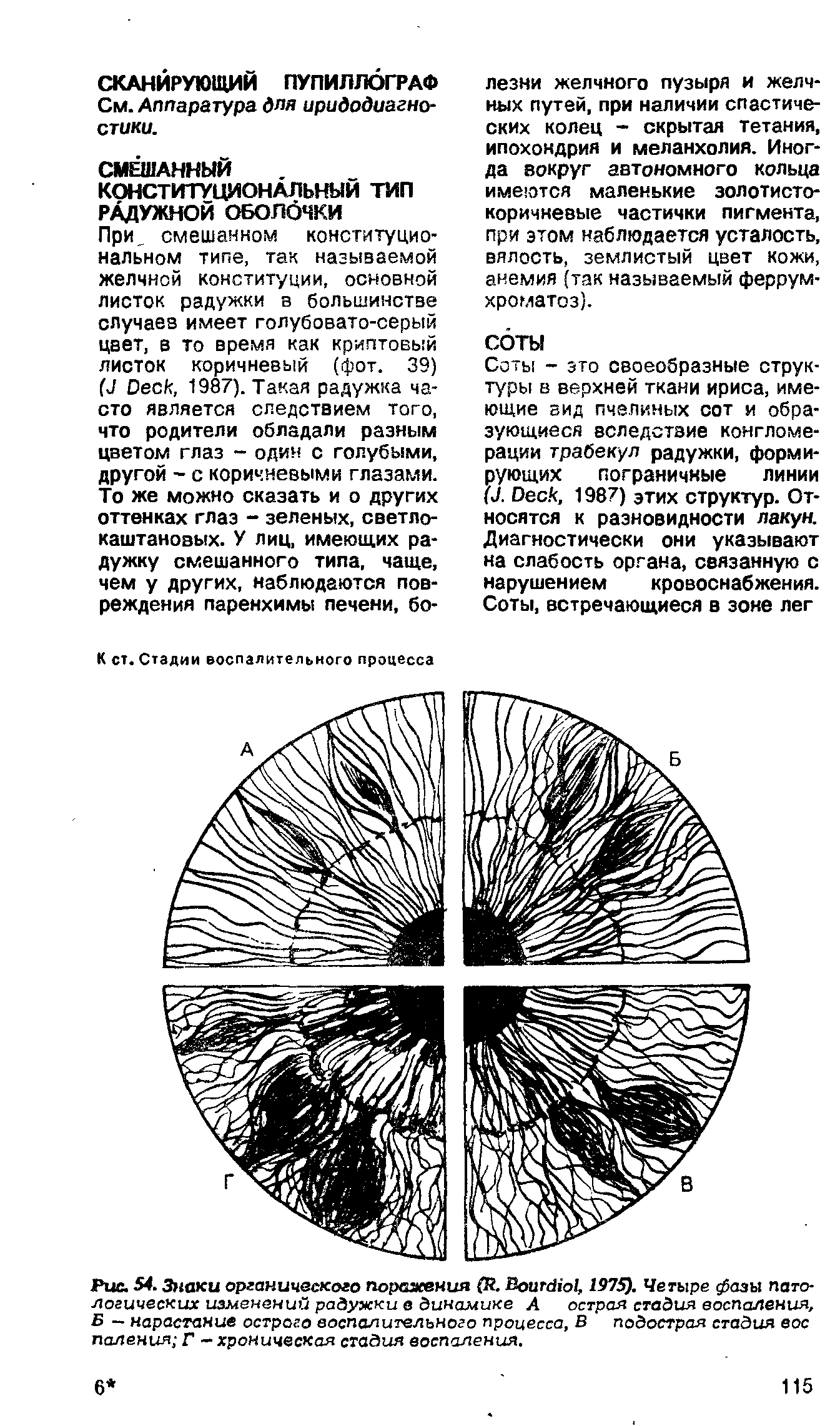 Рис. 54. Знаки органического поражения (Я. ВоитсНо , 1975). Четыре фазы патологических изменений радужки в динамике А острая стадия воспаления, Б — нарастание острого воспалительного процесса, В подострая стадия вое паления Г — хроническая стадия воспаления.