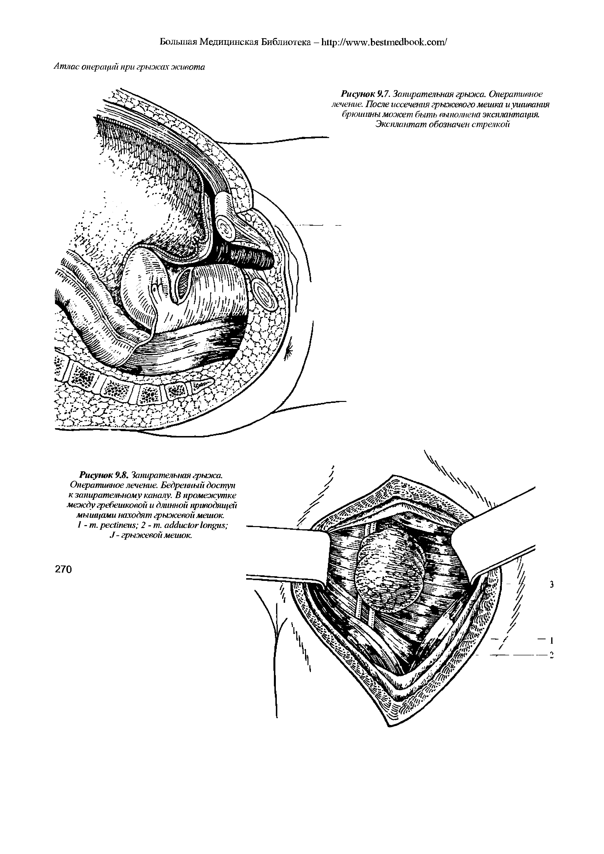 Рисунок 9.8. Запирательная грыжа. Оперативное лечение. Бедренный доступ к запирательному каналу. В промежутке между гребешковой и длинной приводящей мышцами находят грыжевой мешок 1 - . 2 -т. J- грыжевой мешок...