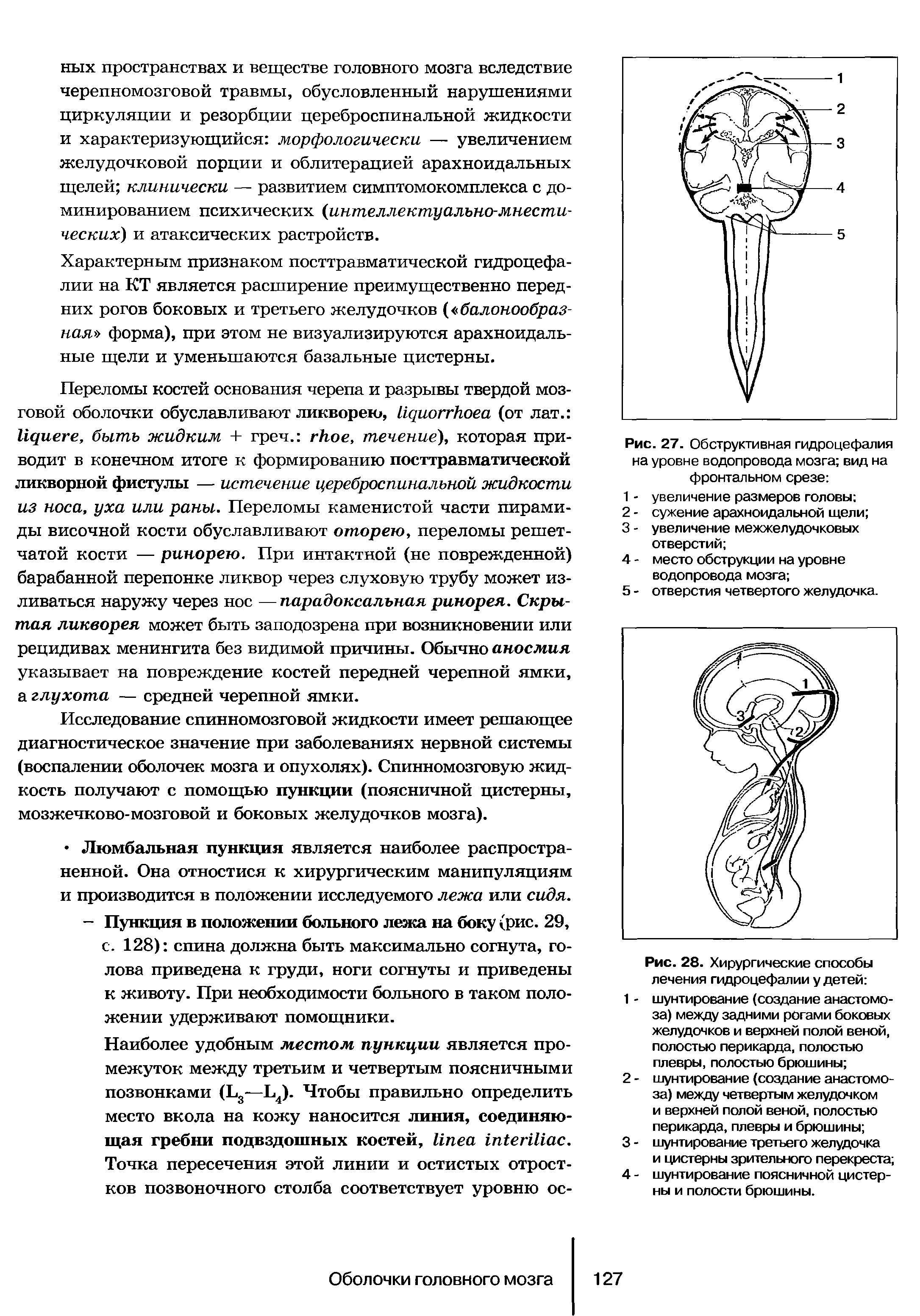 Рис. 27. Обструктивная гидроцефалия на уровне водопровода мозга вид на фронтальном срезе ...