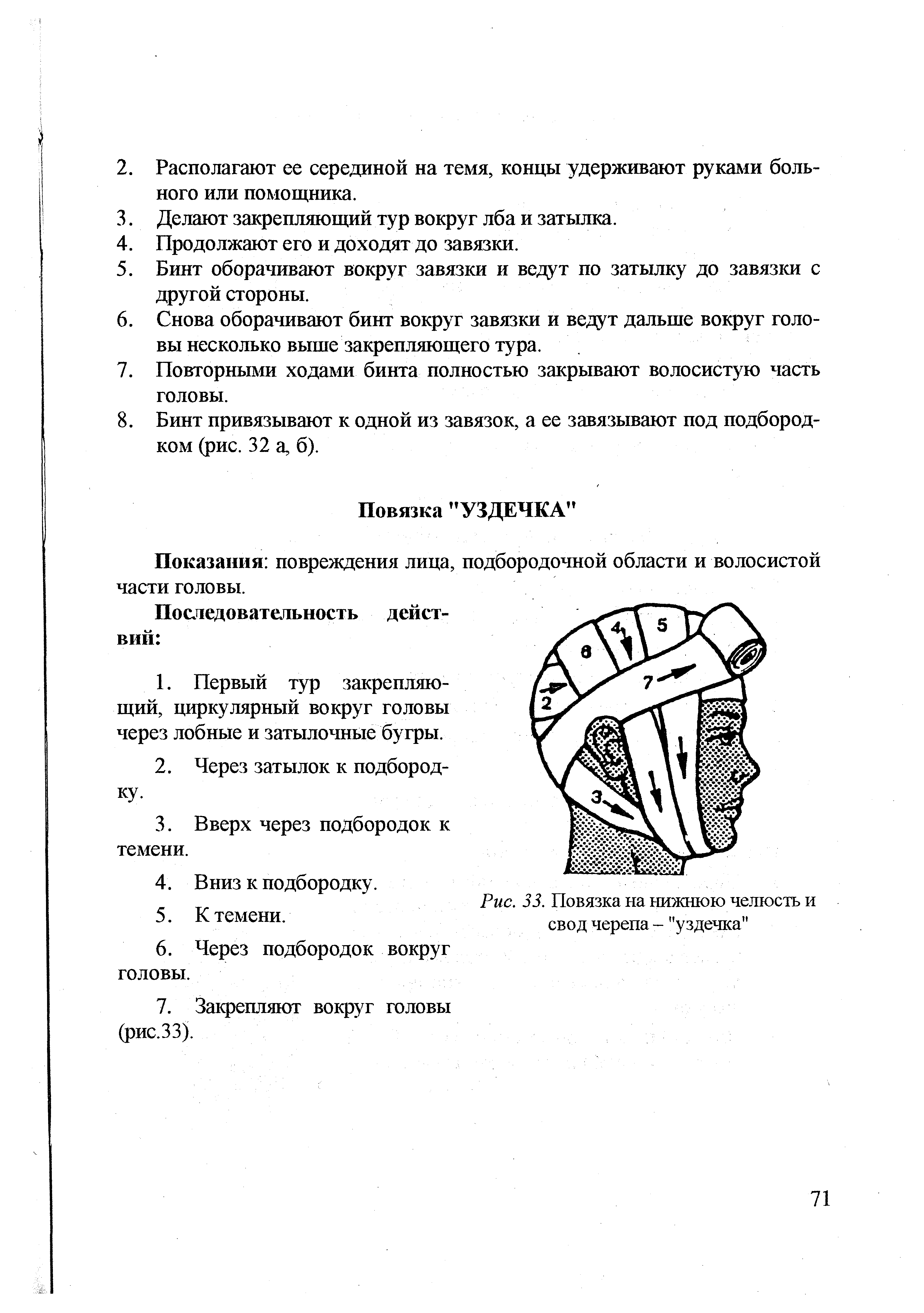 Рис. 33. Повязка на нижнюю челюсть и свод черепа - "уздечка"...