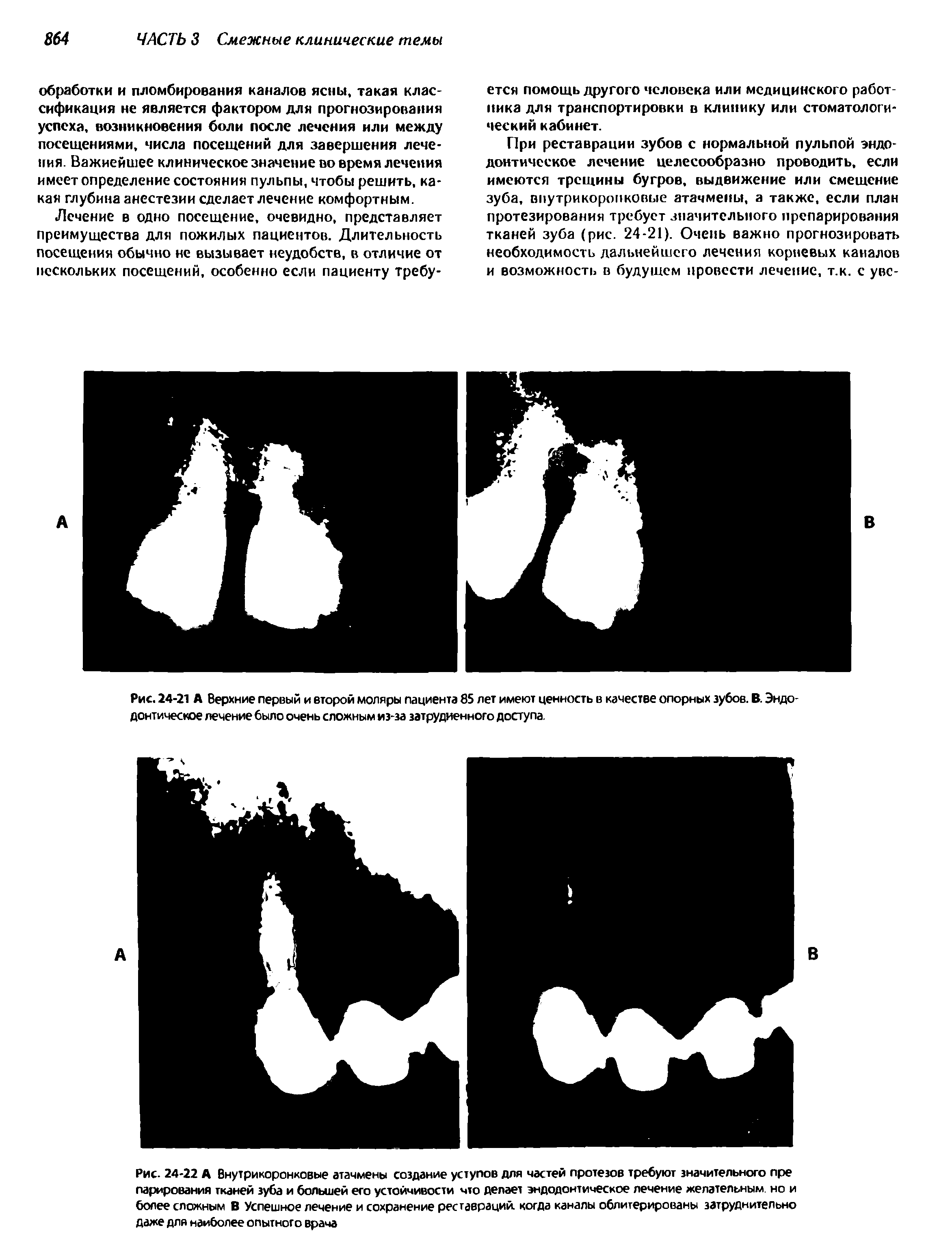 Рис. 24-22 А Внутрикоронковые атачмены создание уступов для частей протезов требуют значительного пре парирования тканей зуба и большей его устойчивости что делает эндодонтическое лечение желательным, но и более сложным В Успешное лечение и сохранение реставраций, когда каналы облитерированы затруднительно даже для наиболее опытного врача...