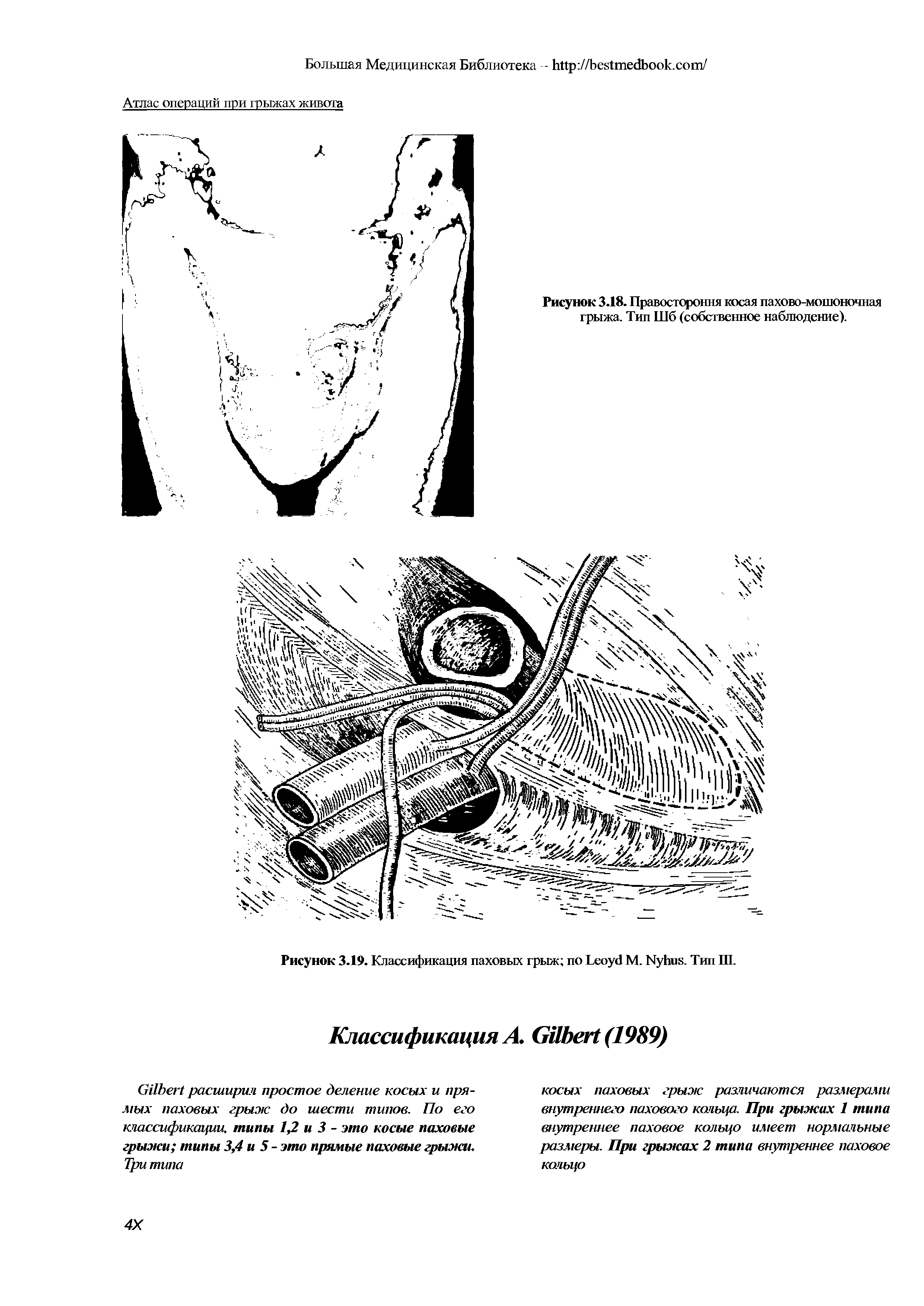 Рисунок 3.18. Правостороння косая пахово-мошоночная грыжа. Тип Шб (собственное наблюдение).