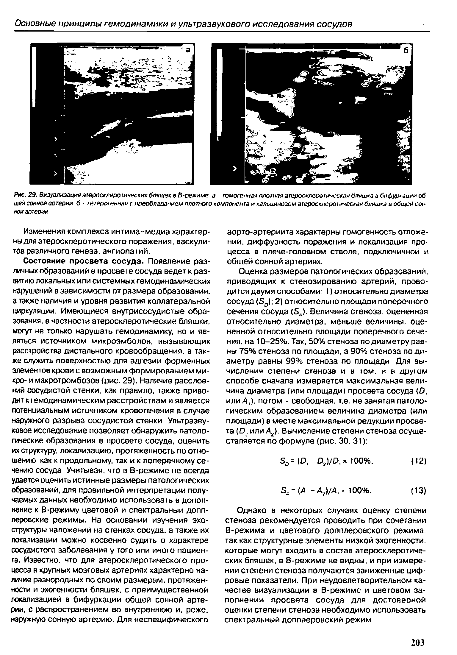 Рис. 29. Визуализацияагерос лн Х ичес икбпяшек в В-режиме а гомотопная плошаяатеросюк рот чсская6пяш<а ибиф>р аиии об шеи сонной астерии б- > й/еры инна с. преобладанием плотного компонента и альцинозом эгеросАлероь чос ая бланка и общей сон ноиасторин...