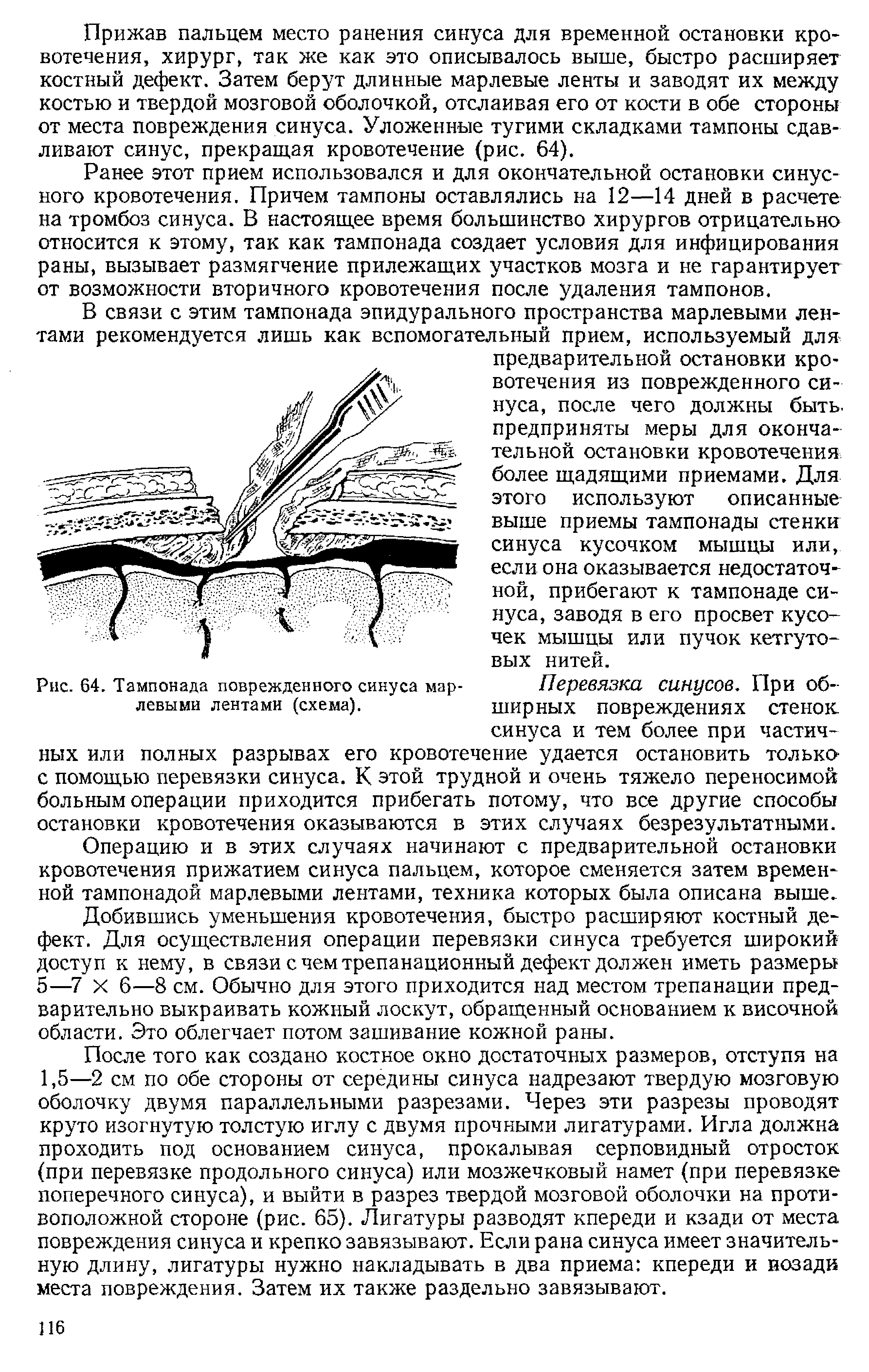 Рис. 64. Тампонада поврежденного синуса марлевыми лентами (схема).