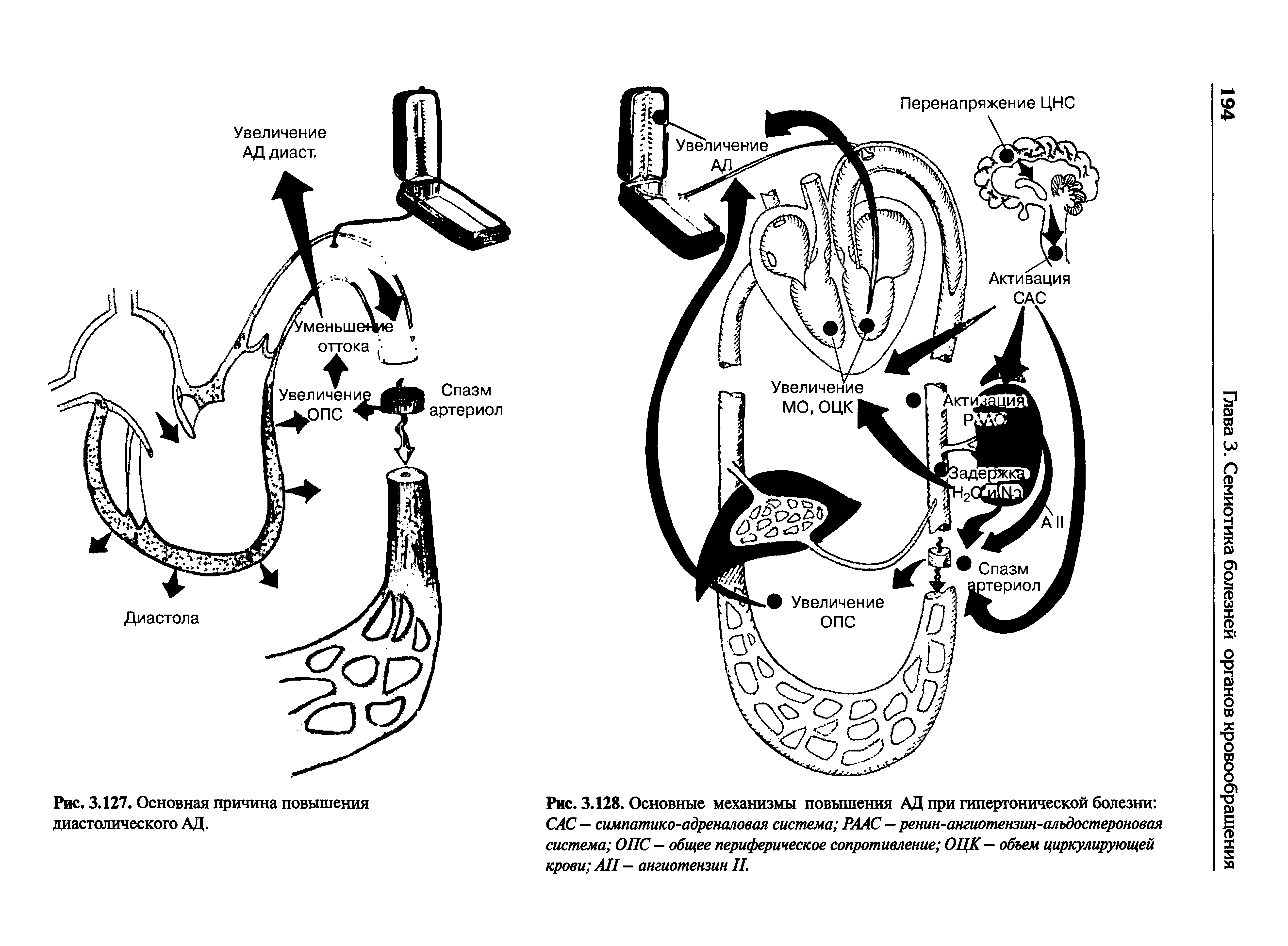 Рис. 3.128. Основные механизмы повышения АД при гипертонической болезни САС — симпатико-адреналовая система РААС - ренин-ангиотензин-алъдостероновая система ОПС - общее периферическое сопротивление ОЦК — объем циркулирующей крови A — ангиотензин IL...