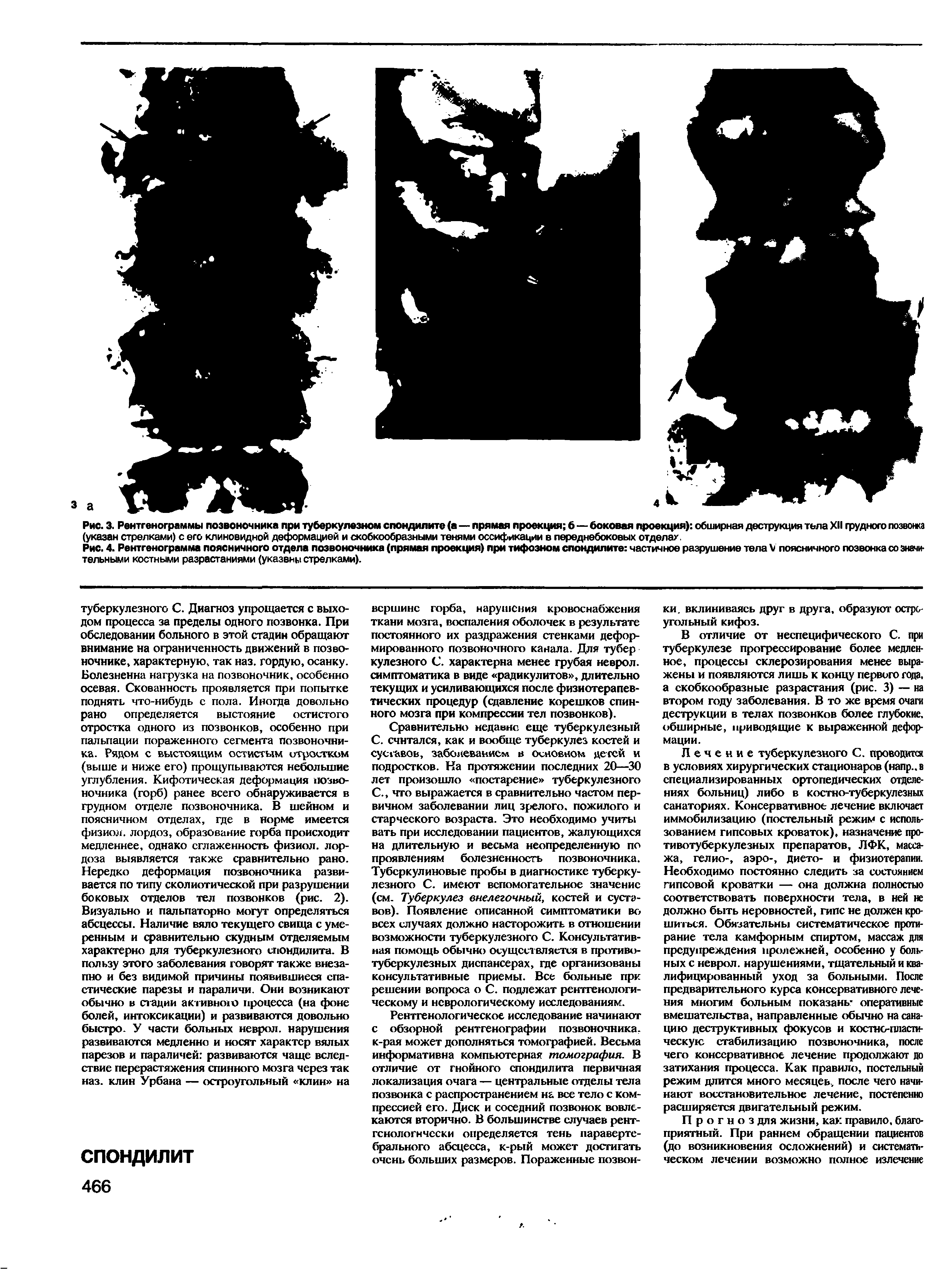 Рис. 4. Рентгенограмма поясничного отдела позвоночника (прямая проекция) при тифозном спондилите частичное разрушение тела V поясничного позвонка со значительными костными разрастаниями (указвны стрелками).