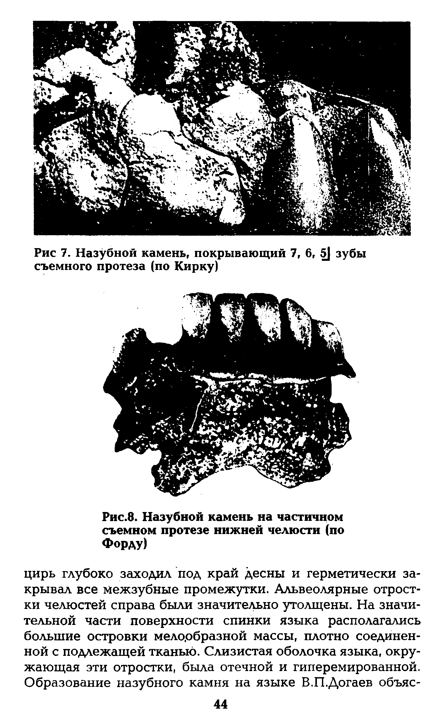 Рис.8. Назубной камень на частичном съемном протезе нижней челюсти (по Форду)...