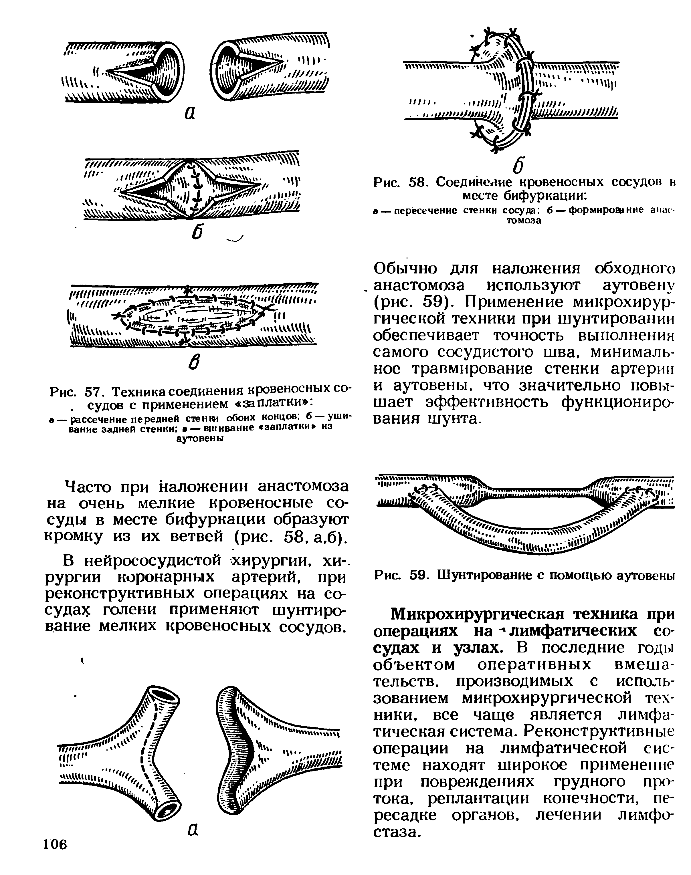 Рис. 57. Техника соединения кровеносных сосудов с применением заплатки ...