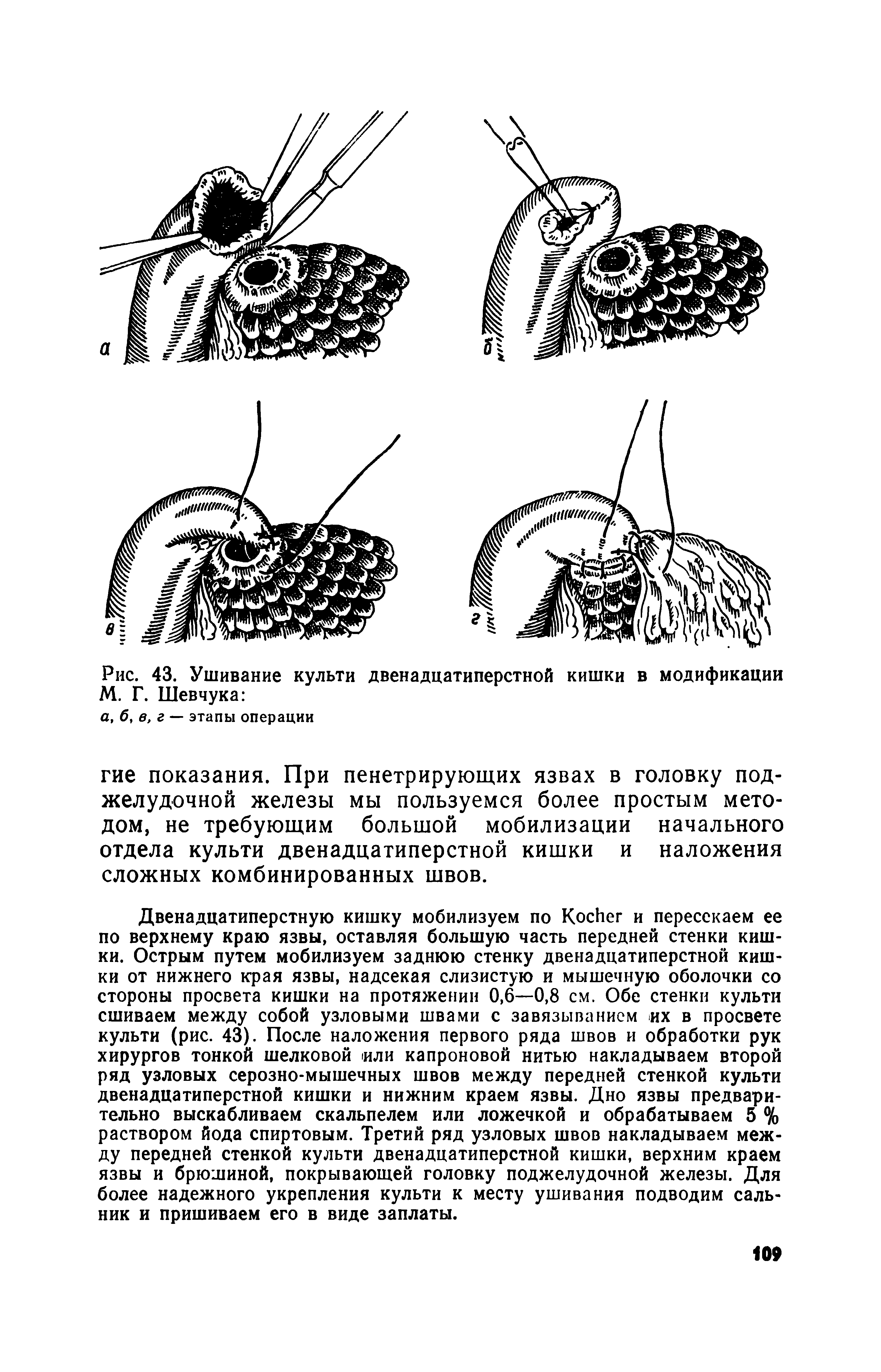 Рис. 43. Ушивание культи двенадцатиперстной кишки в модификации М. Г. Шевчука ...