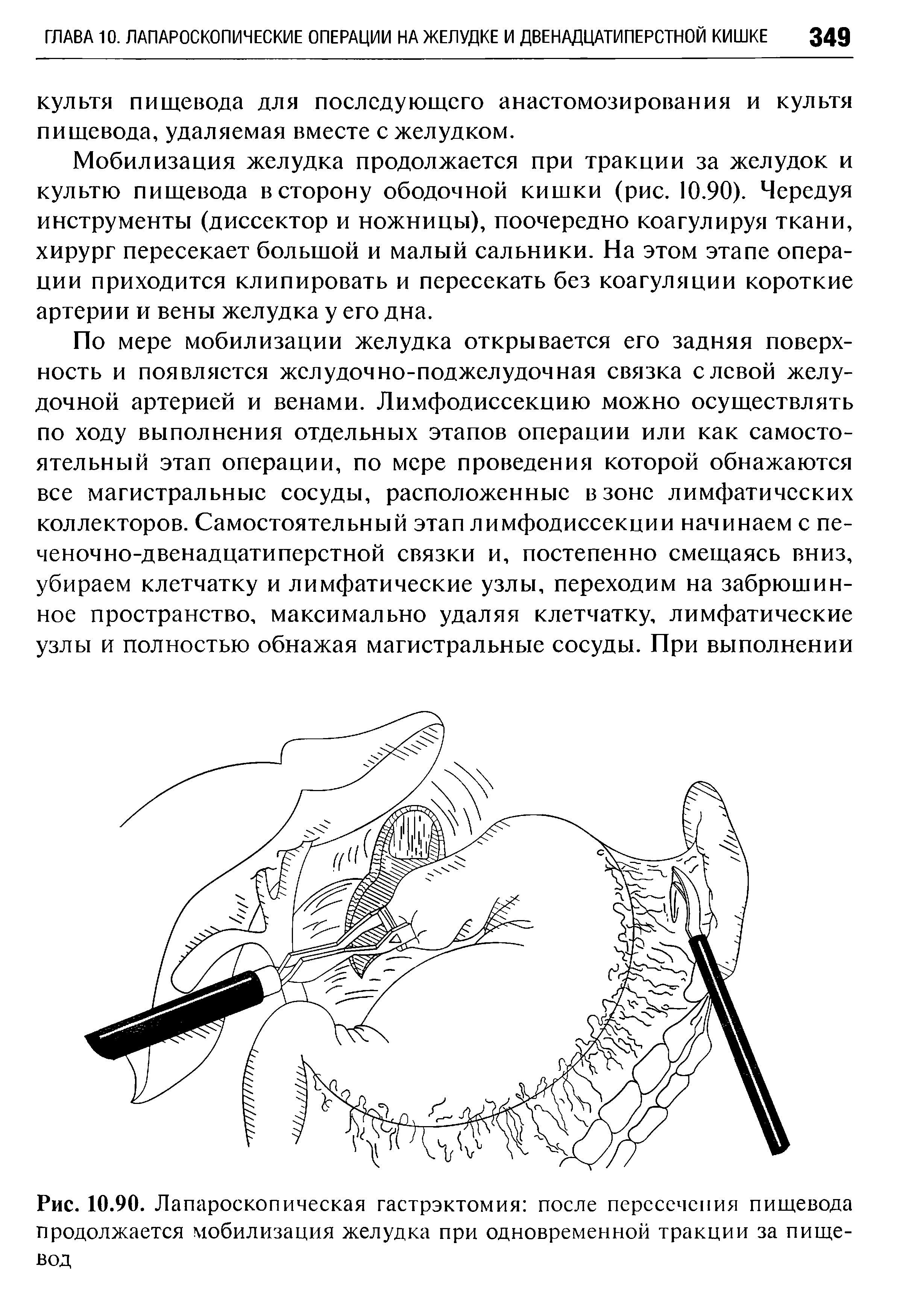 Рис. 10.90. Лапароскопическая гастрэктомия после пересечения пищевода продолжается мобилизация желудка при одновременной тракции за пищевод...