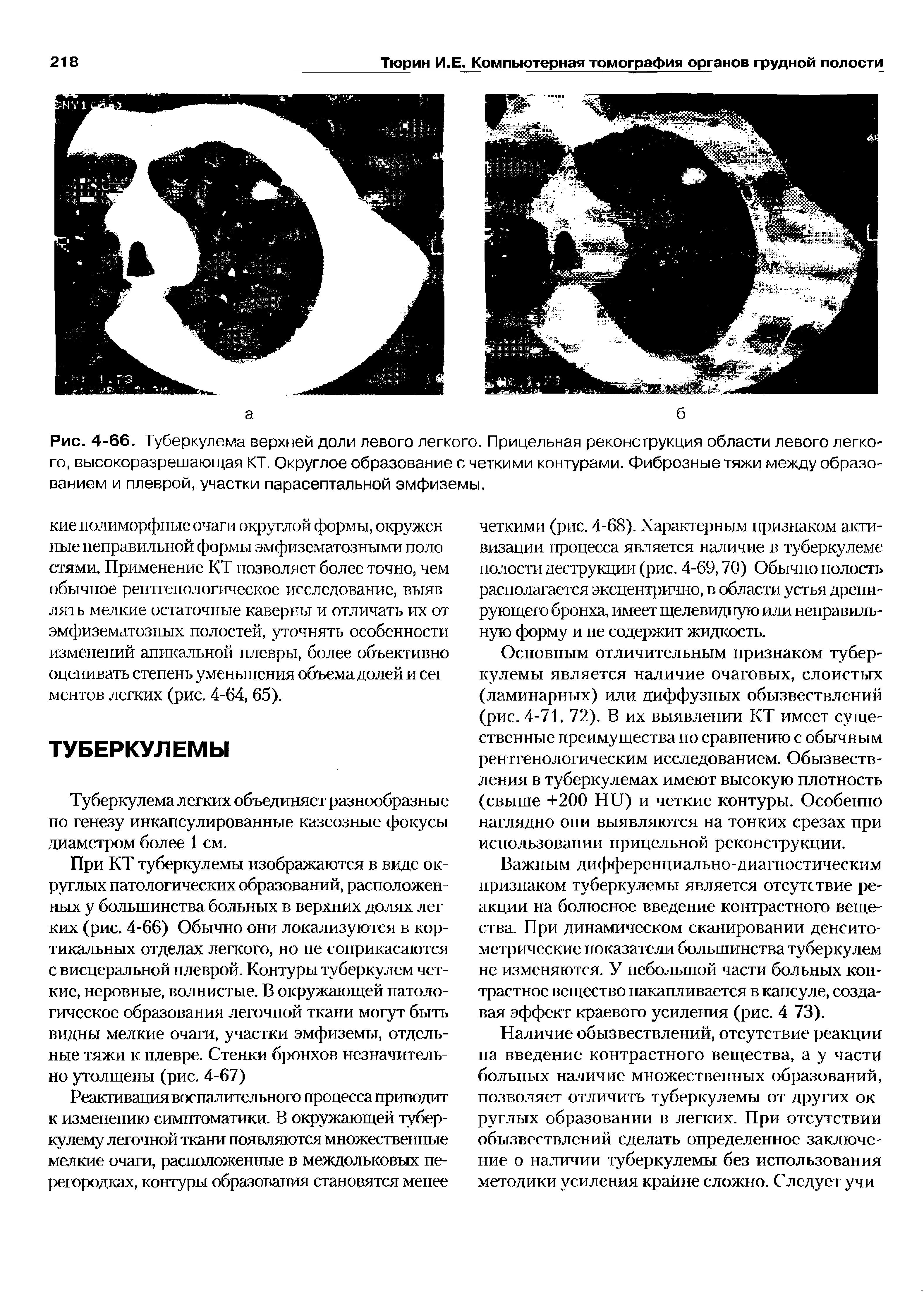 Рис. 4-66. Туберкулема верхней доли левого легкого. Прицельная реконструкция области левого легкого, высокоразрешающая КТ. Округлое образование с четкими контурами. Фиброзные тяжи между образованием и плеврой, участки парасептальной эмфиземы.