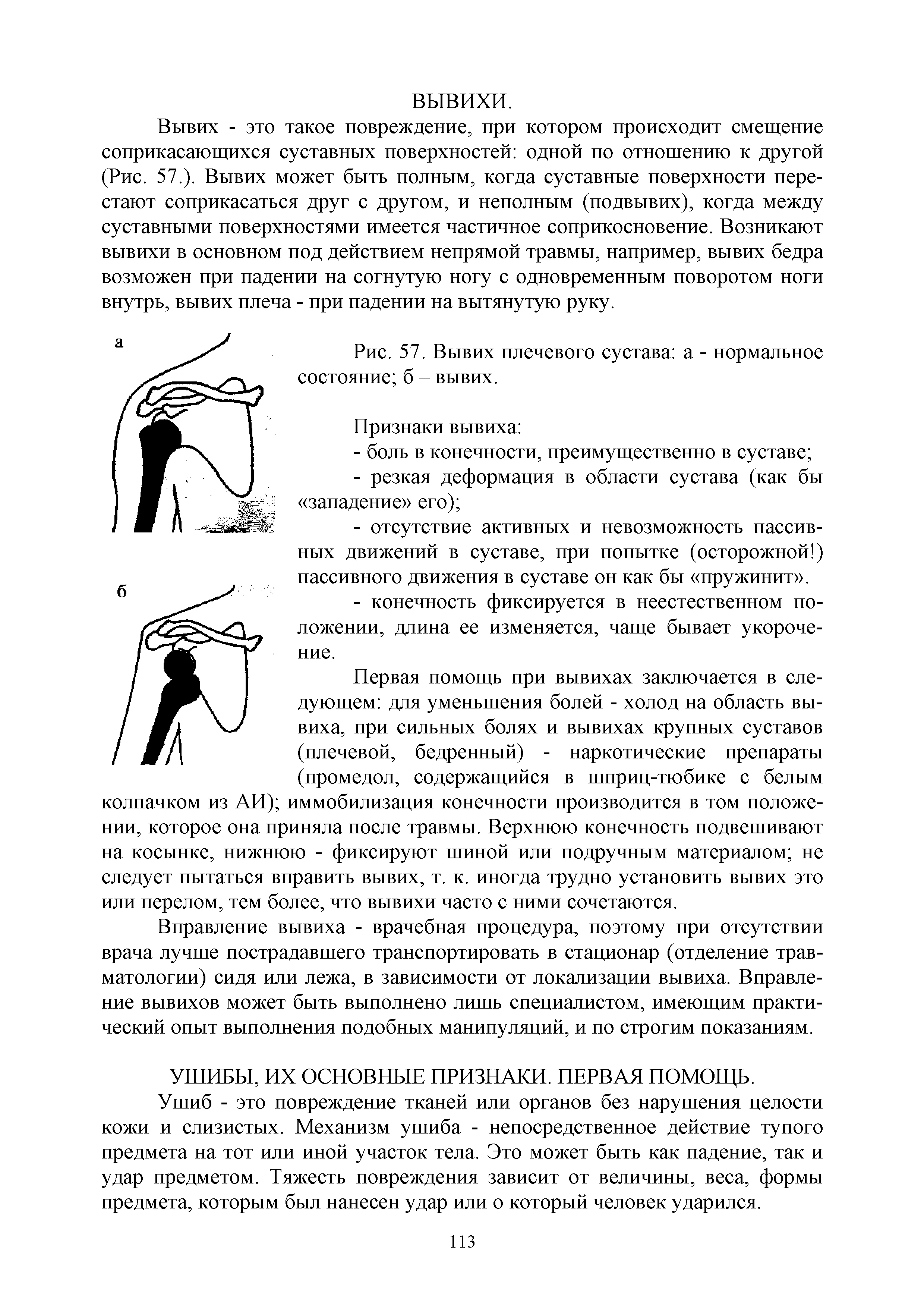 Рис. 57. Вывих плечевого сустава а - нормальное состояние б - вывих.