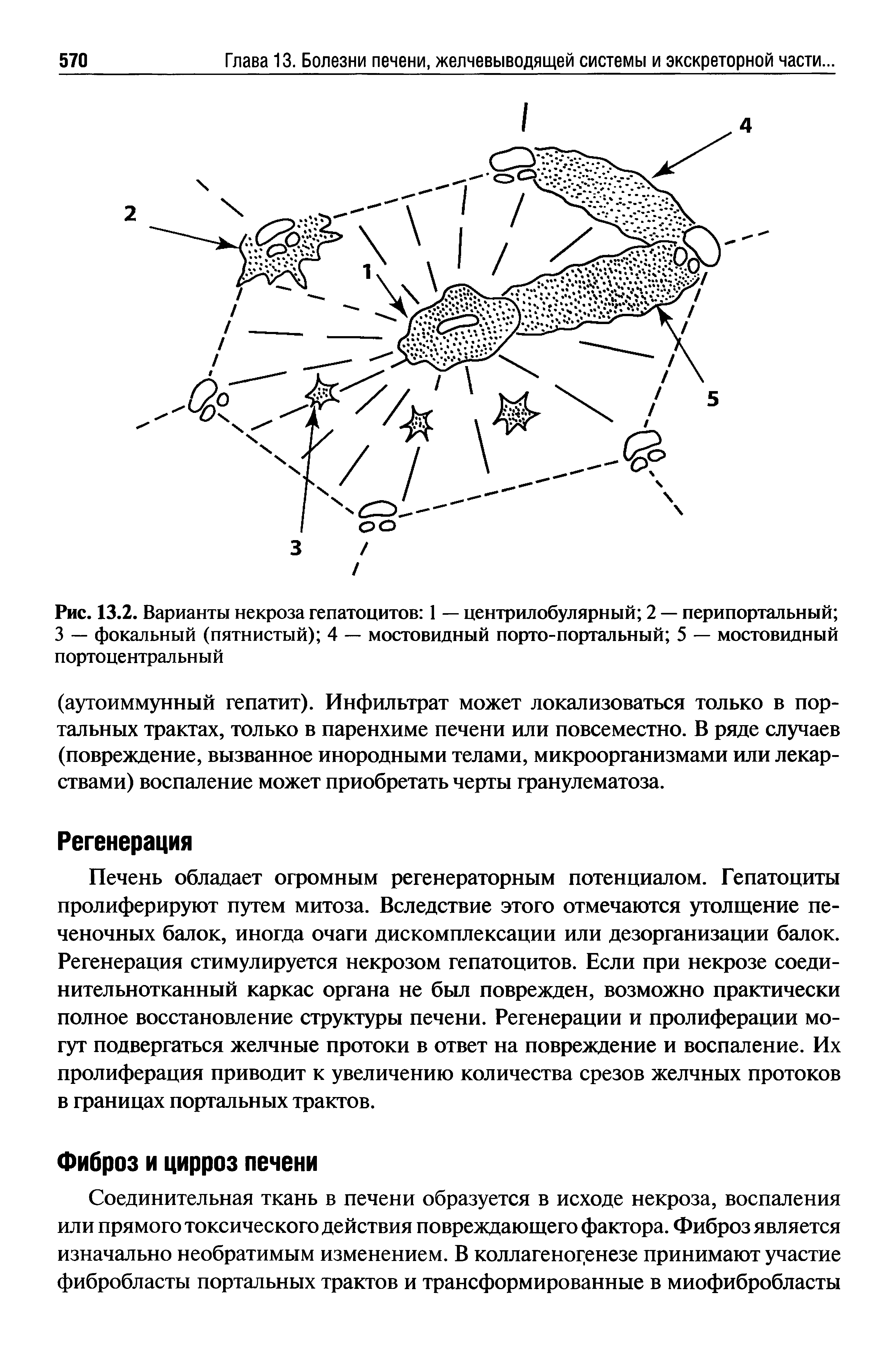 Рис. 13.2. Варианты некроза гепатоцитов 1 — центрилобулярный 2 — перипортальный 3 — фокальный (пятнистый) 4 — мостовидный порто-портальный 5 — мостовидный портоцентральный...